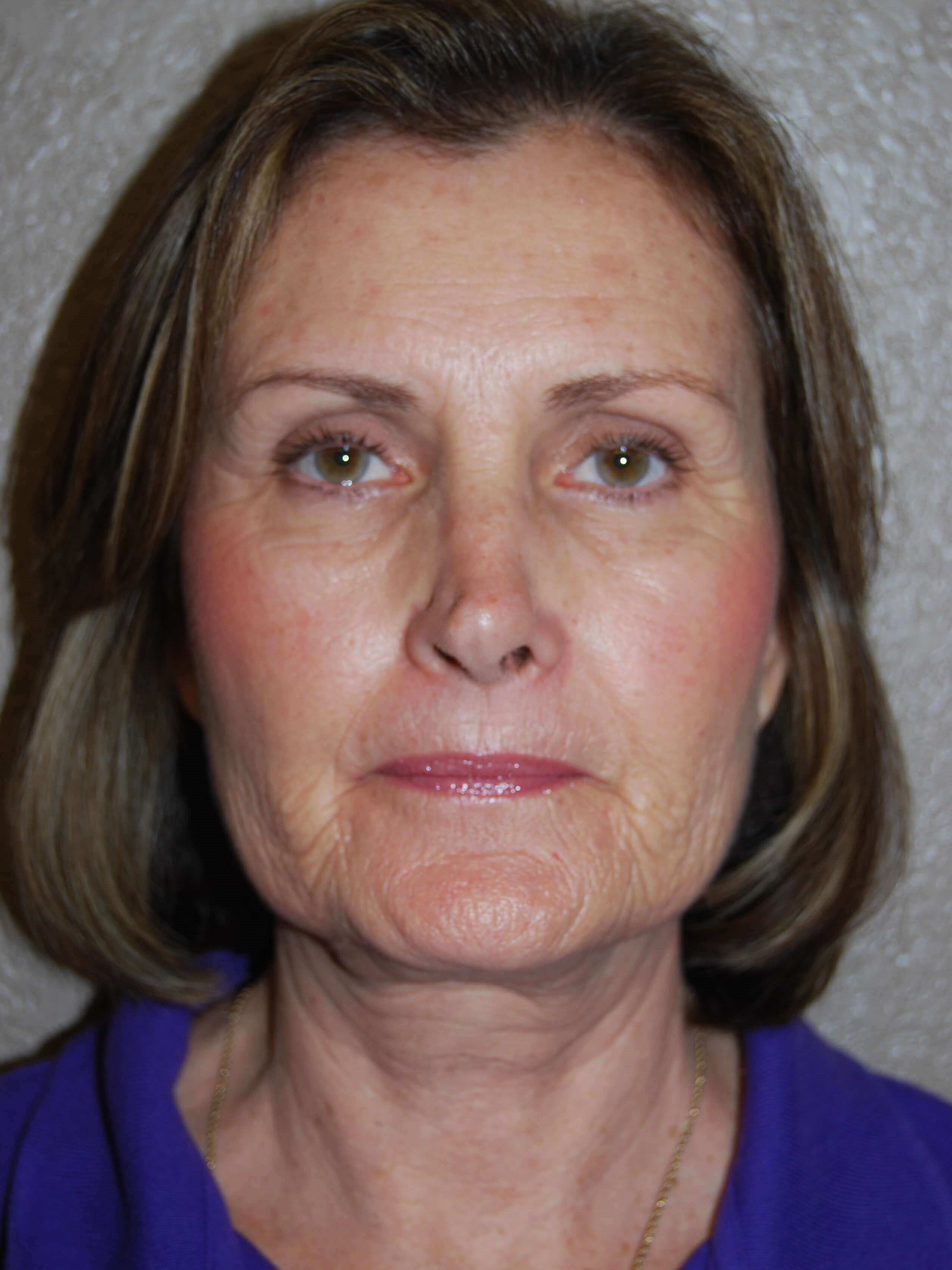 Front Before Mini Face Lift