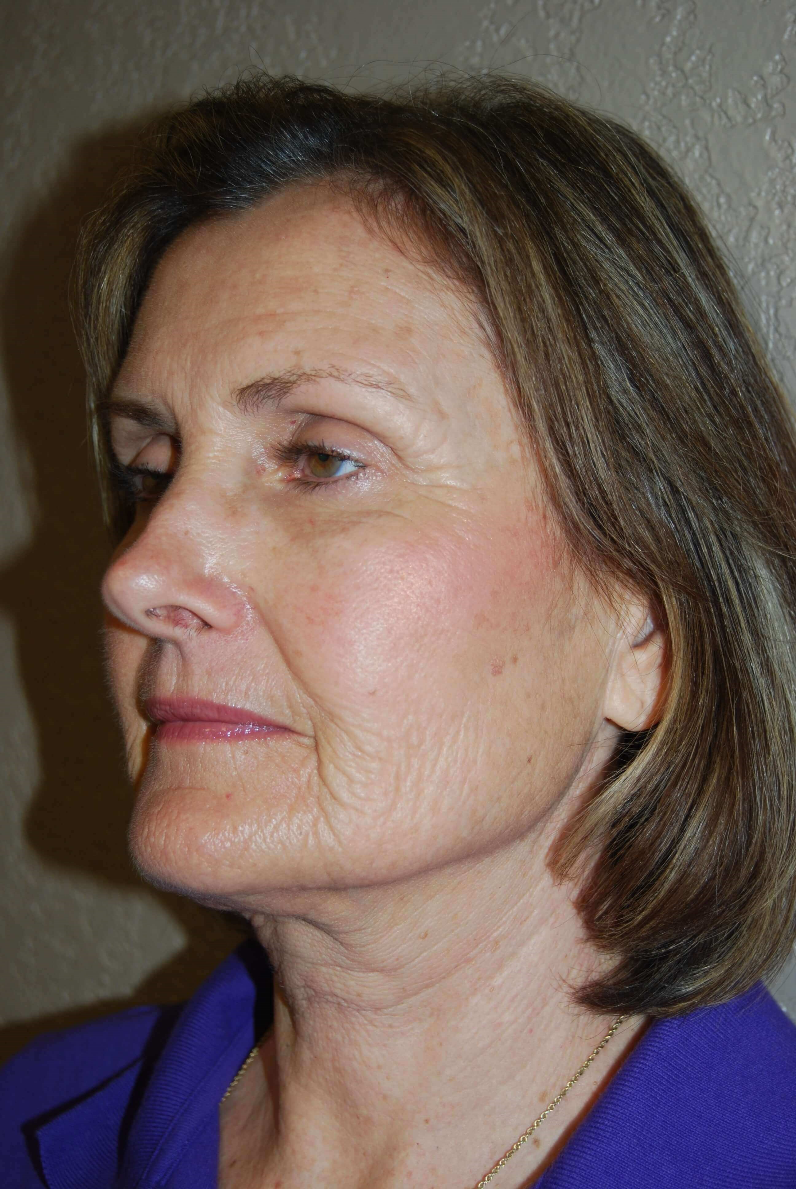 Oblique - Left Before Mini Face Lift