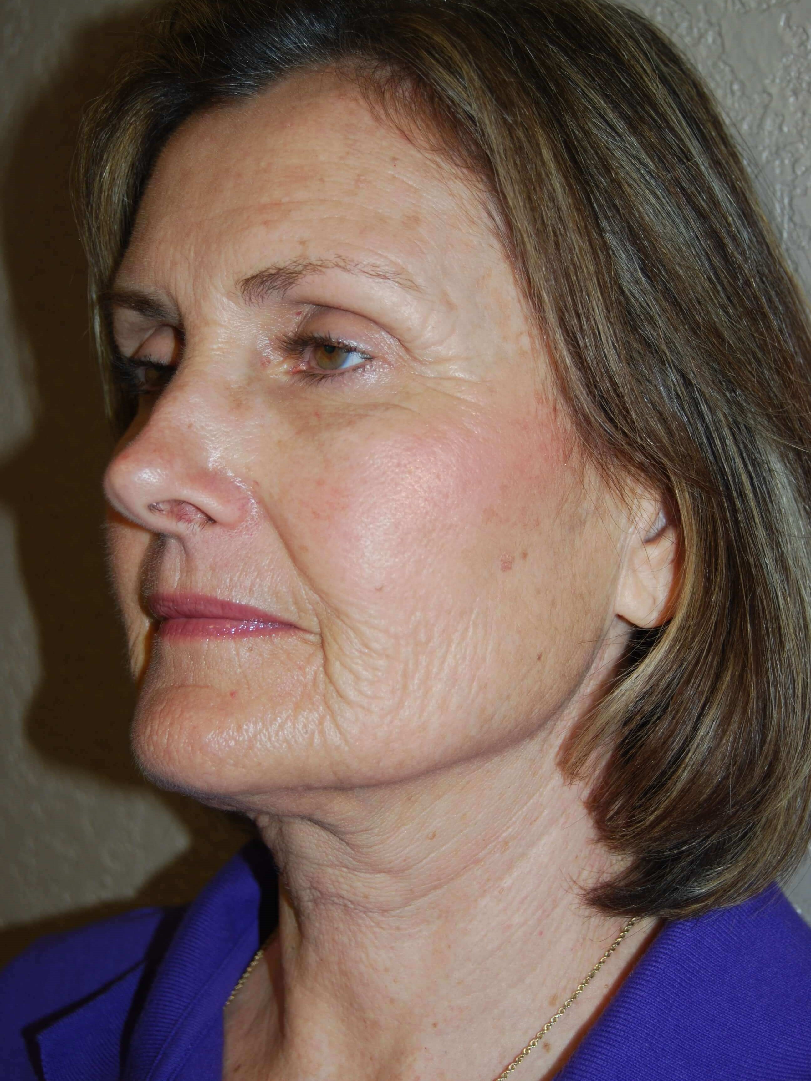 Oblique - Left Before Mini Face Lift