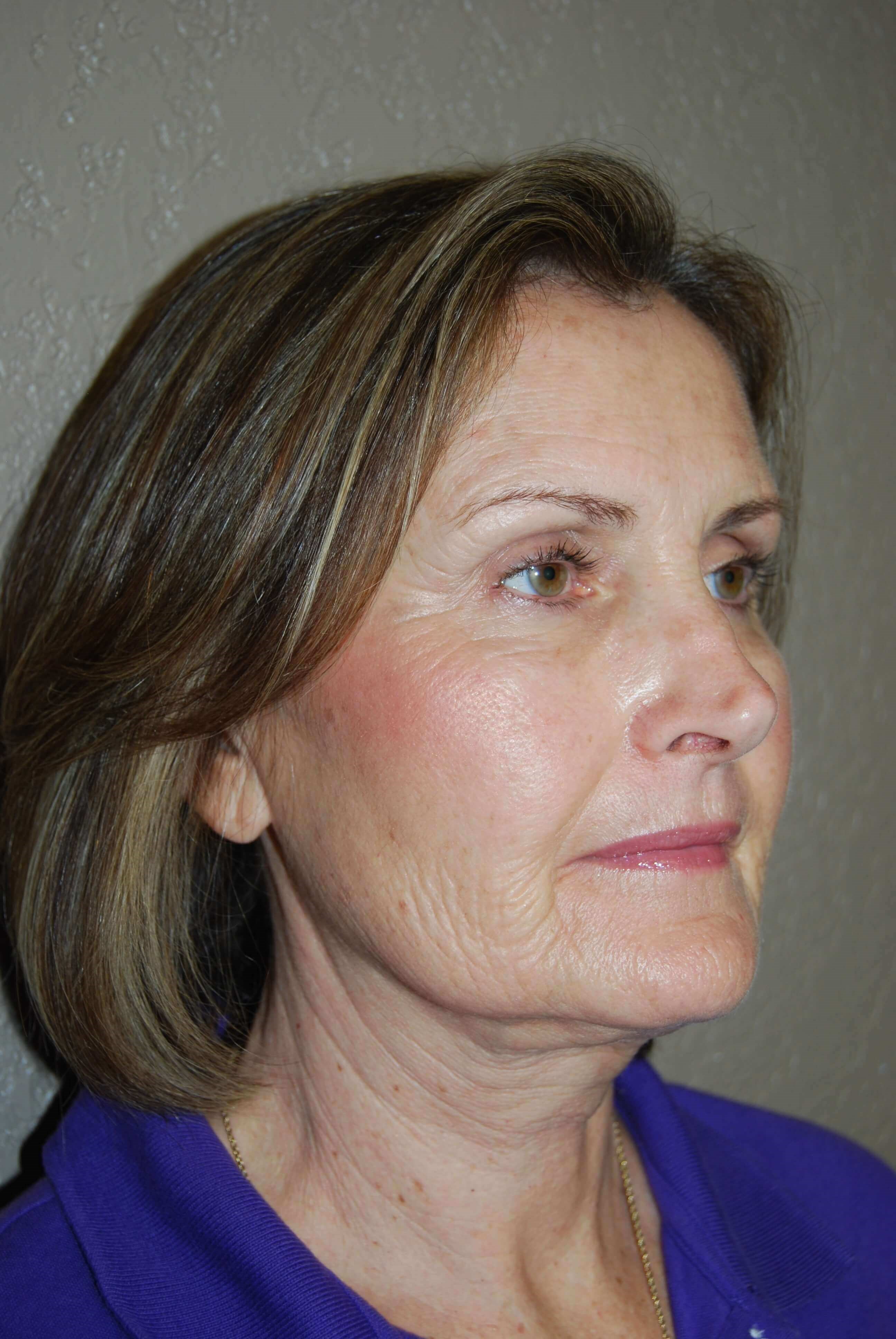 Oblique - Right Before Mini Face Lift