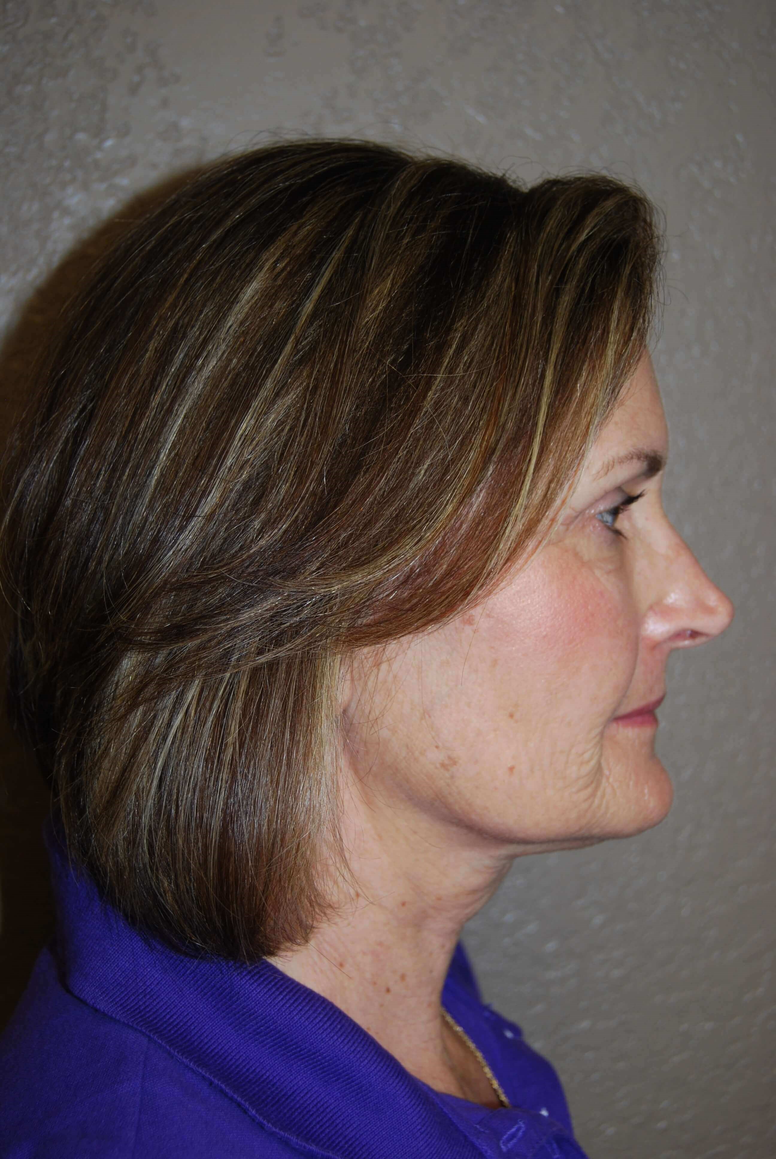 Lateral - Right Before Mini Face Lift