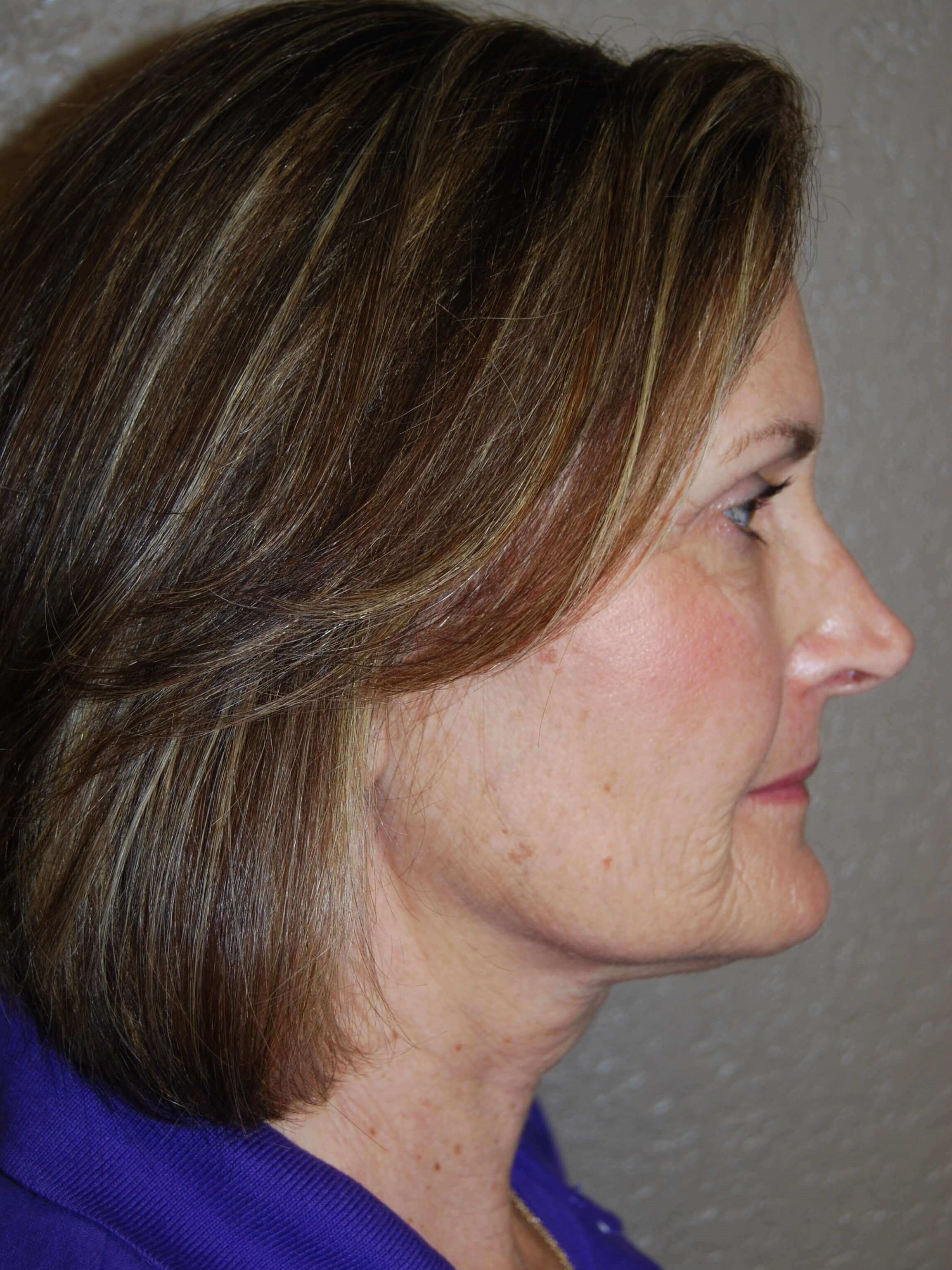 Lateral - Right Before Mini Face Lift