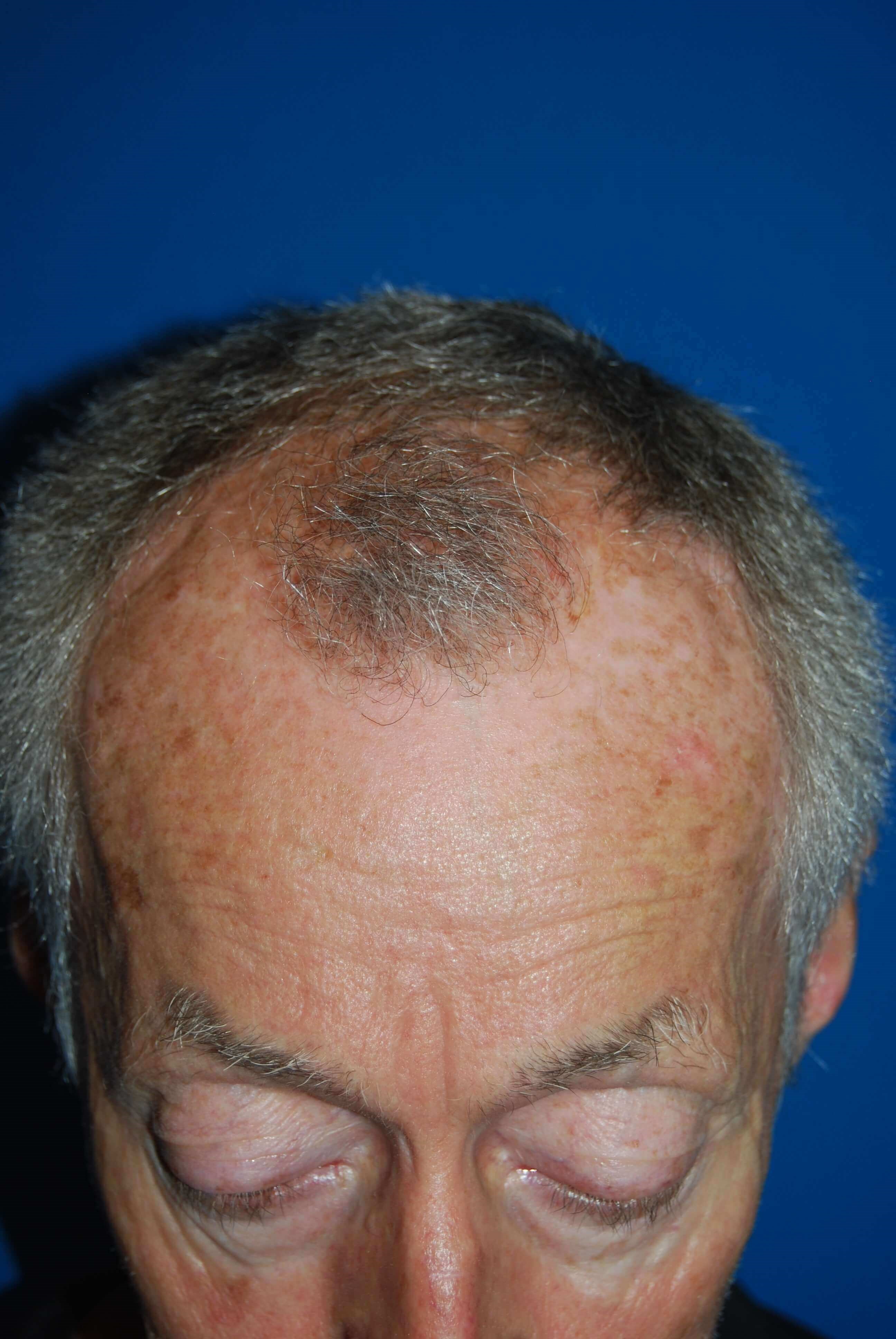 Hair Transplant Before & After Before Hair Transplant