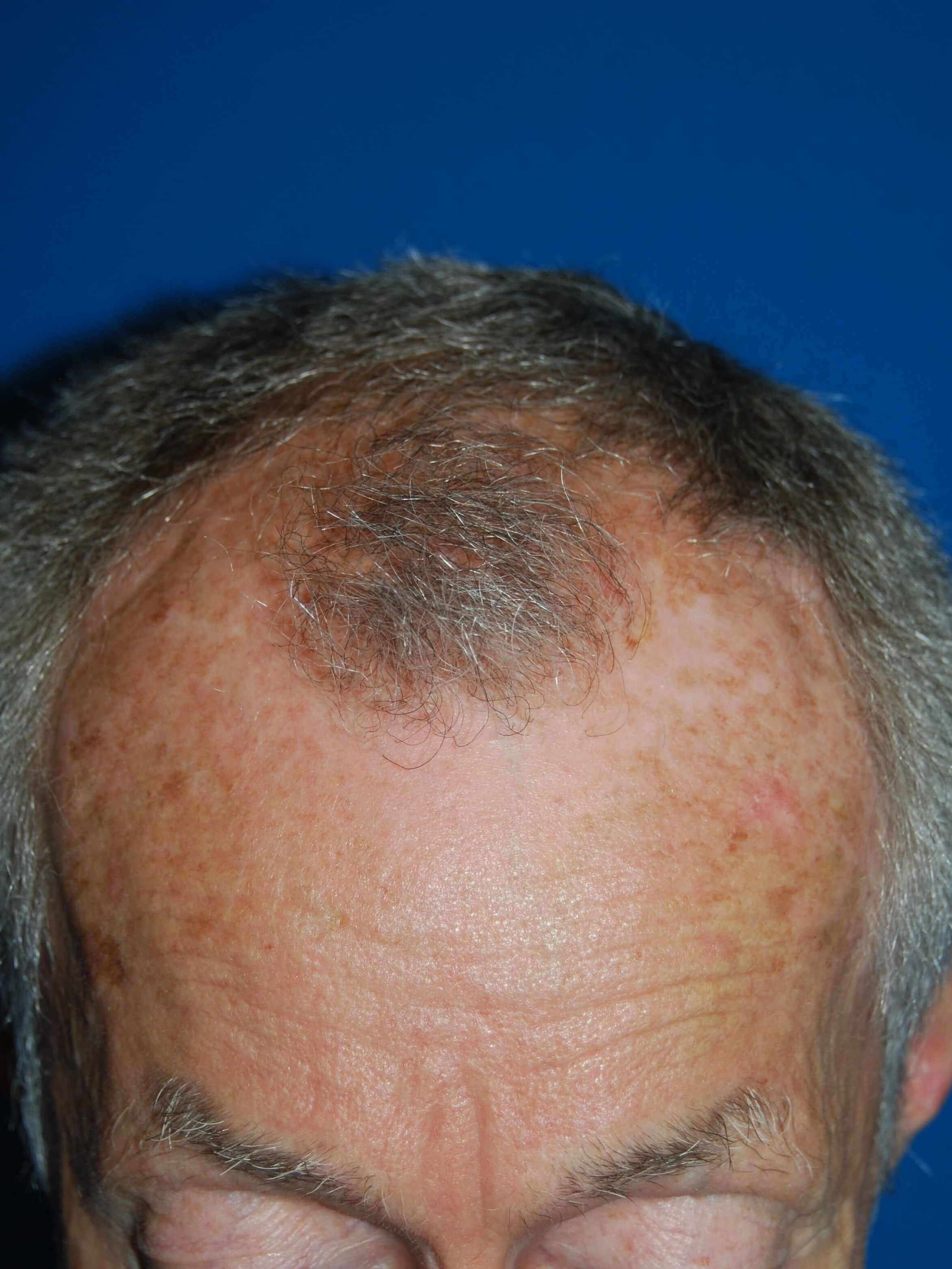 Hair Transplant Before & After Before Hair Transplant