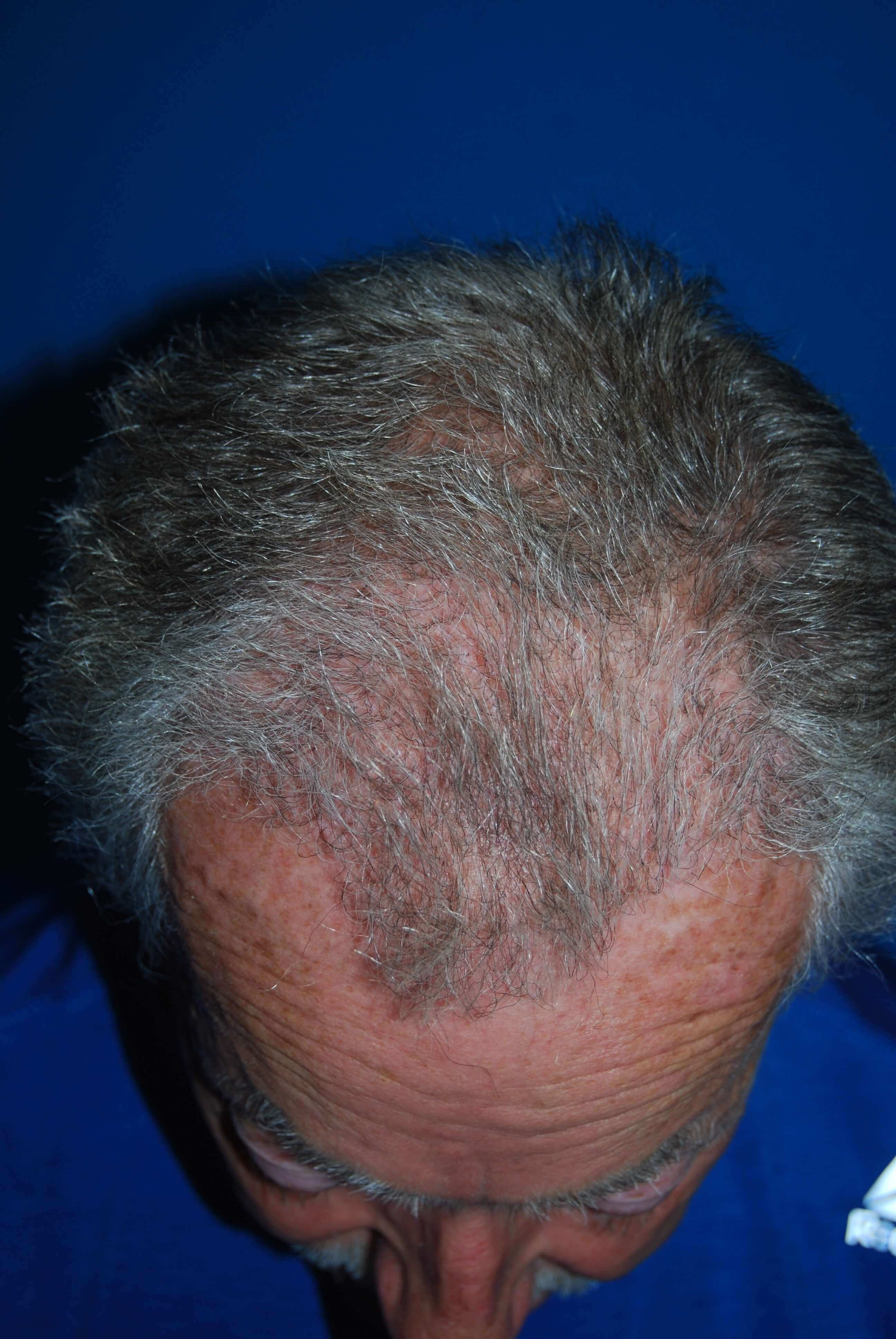 Hair Transplant Before & After After Hair Transplant