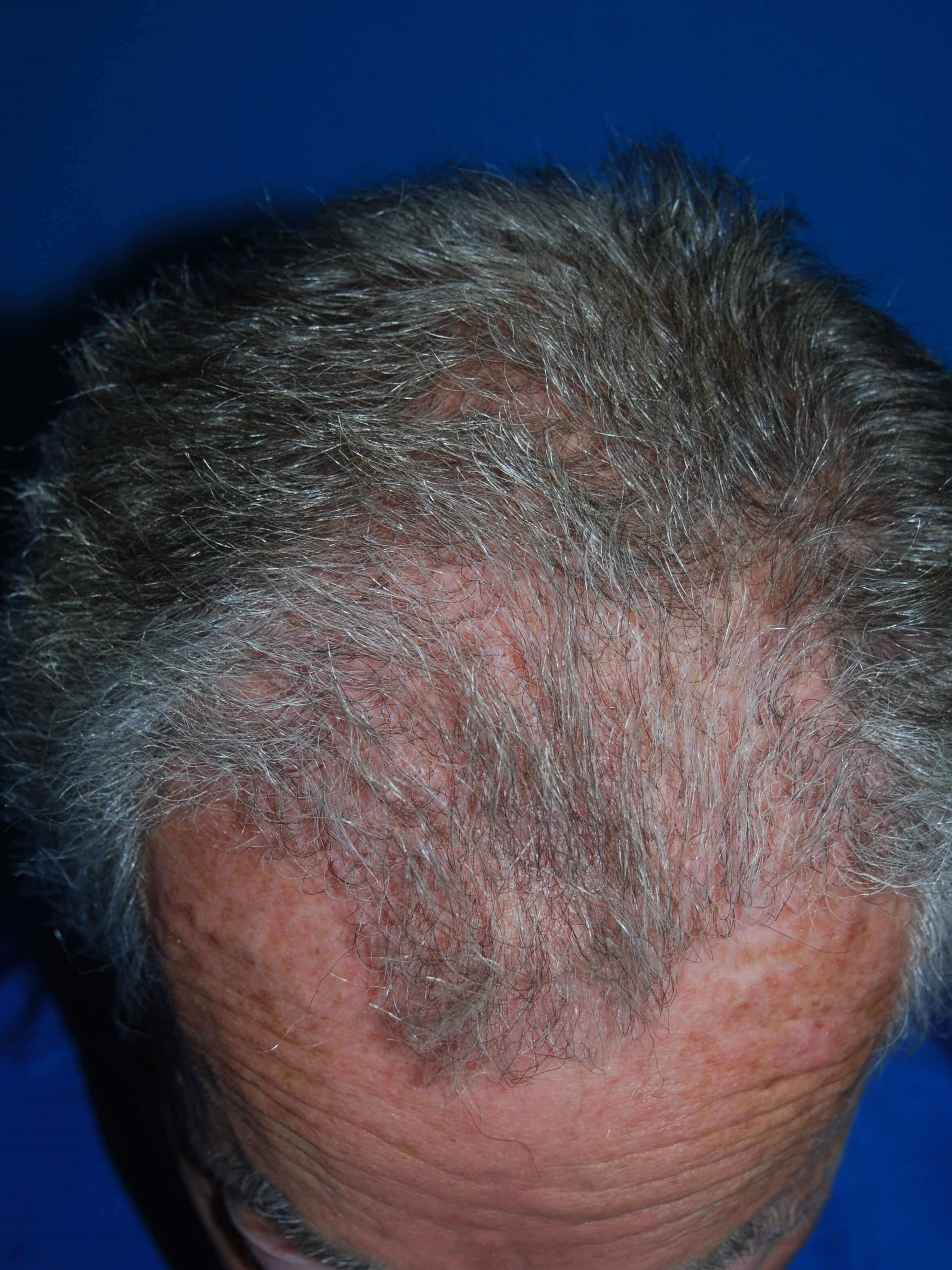 Hair Transplant Before & After After Hair Transplant