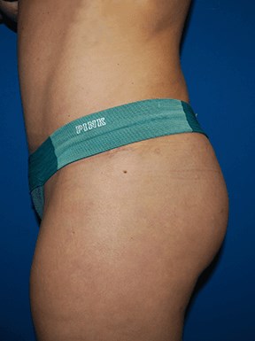 Lateral After BBL