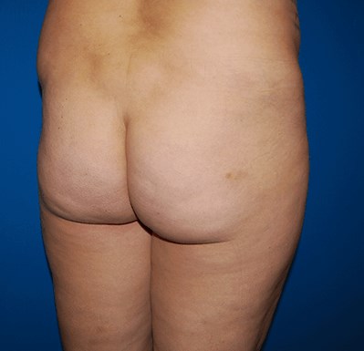 Oblique Before BBL