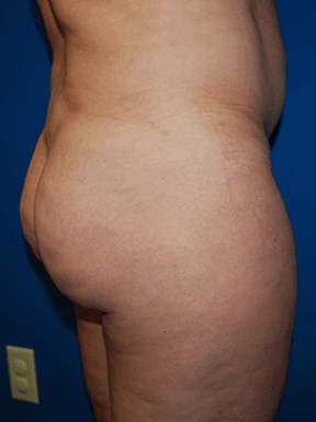 Lateral Before BBL