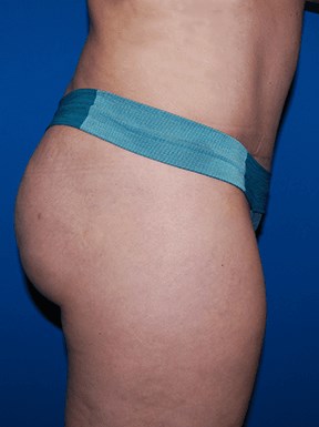 Lateral After BBL