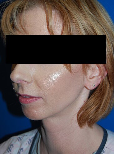 Oblique - Left Before