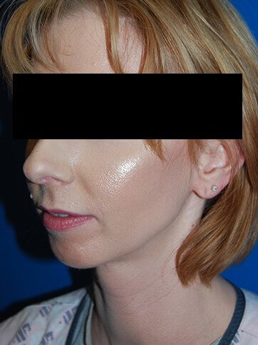 Oblique - Left Before