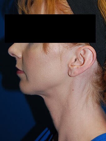 Lateral - Left After