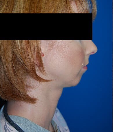 Lateral - Right Before