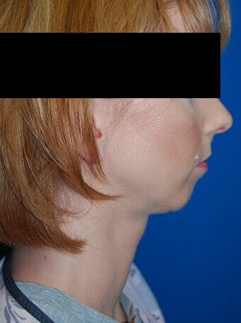 Lateral - Right Before