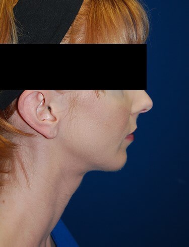 Lateral - Right After