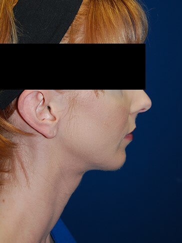 Lateral - Right After