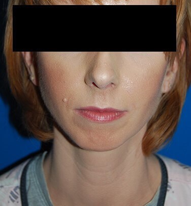 Front Before
