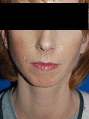 Front Before