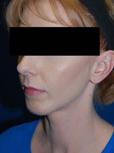 Oblique - Left After
