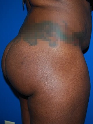 Lateral - Right After BBL