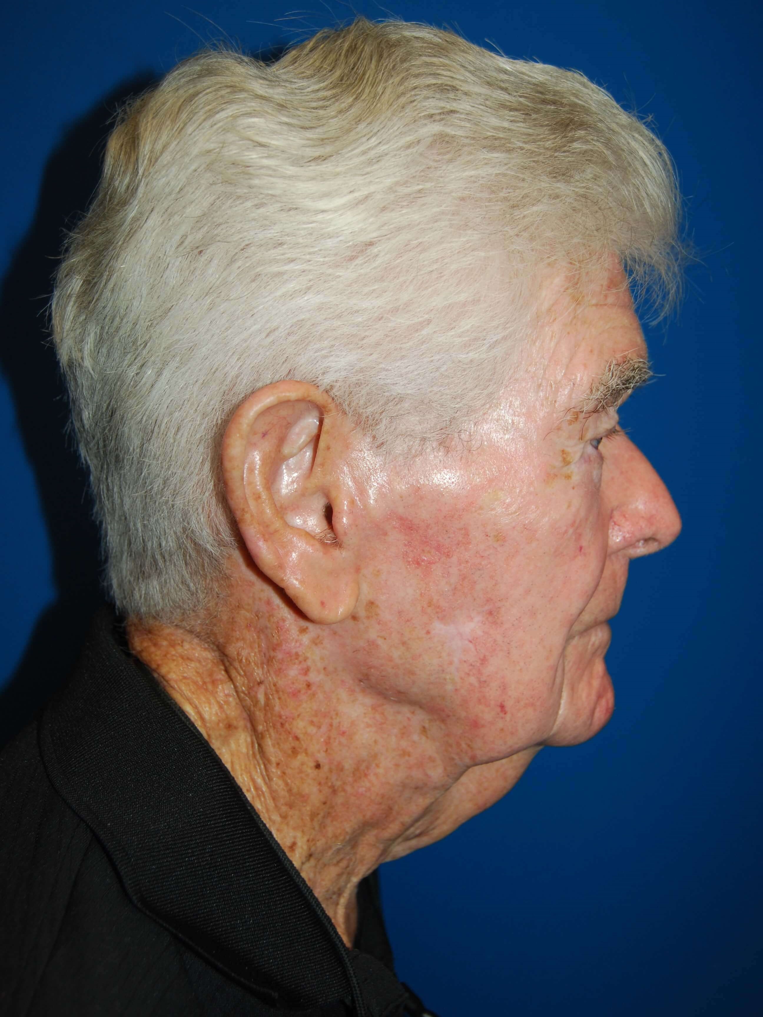 Lateral Before Neck Lift