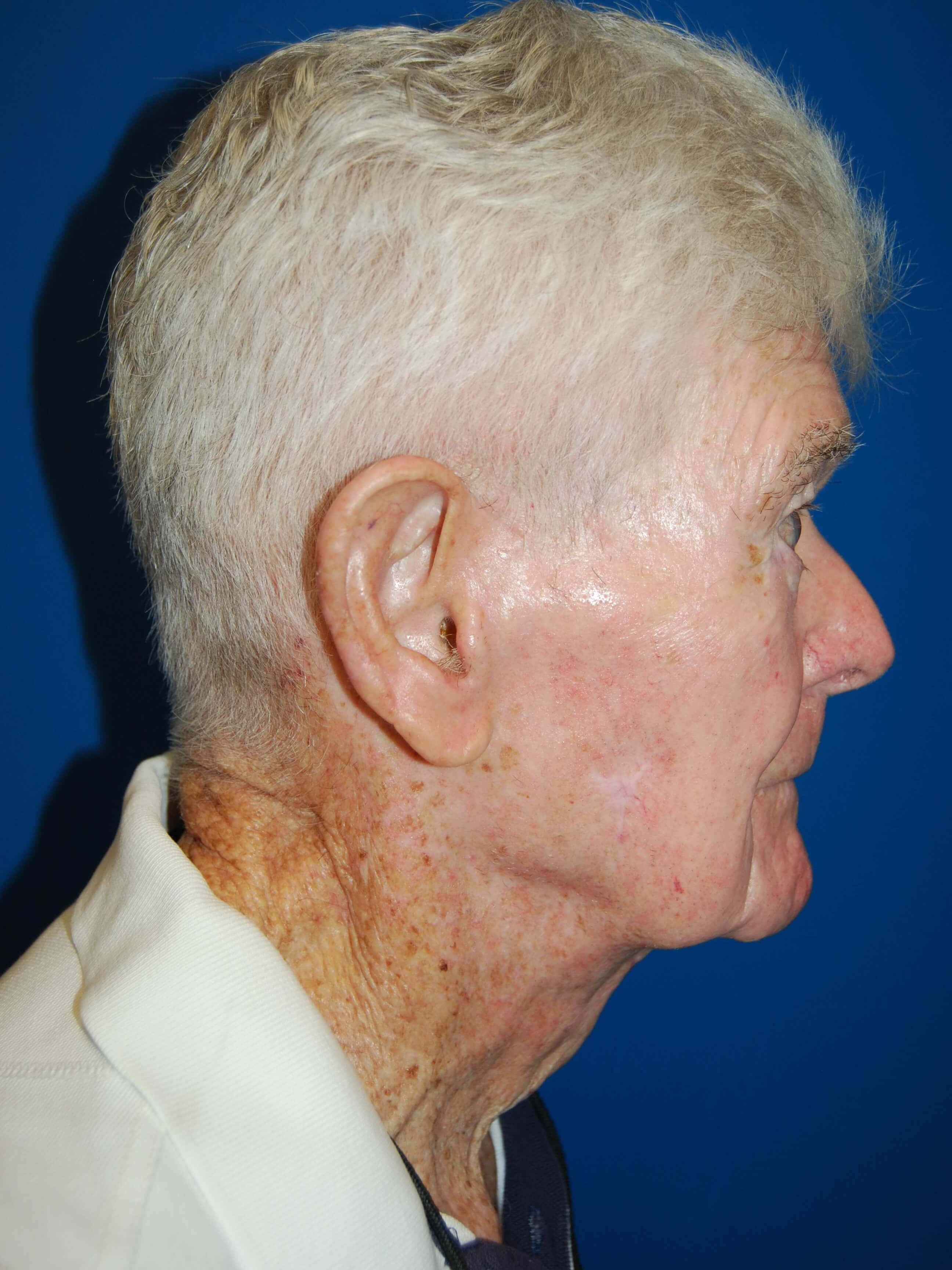 Lateral After Neck Lift