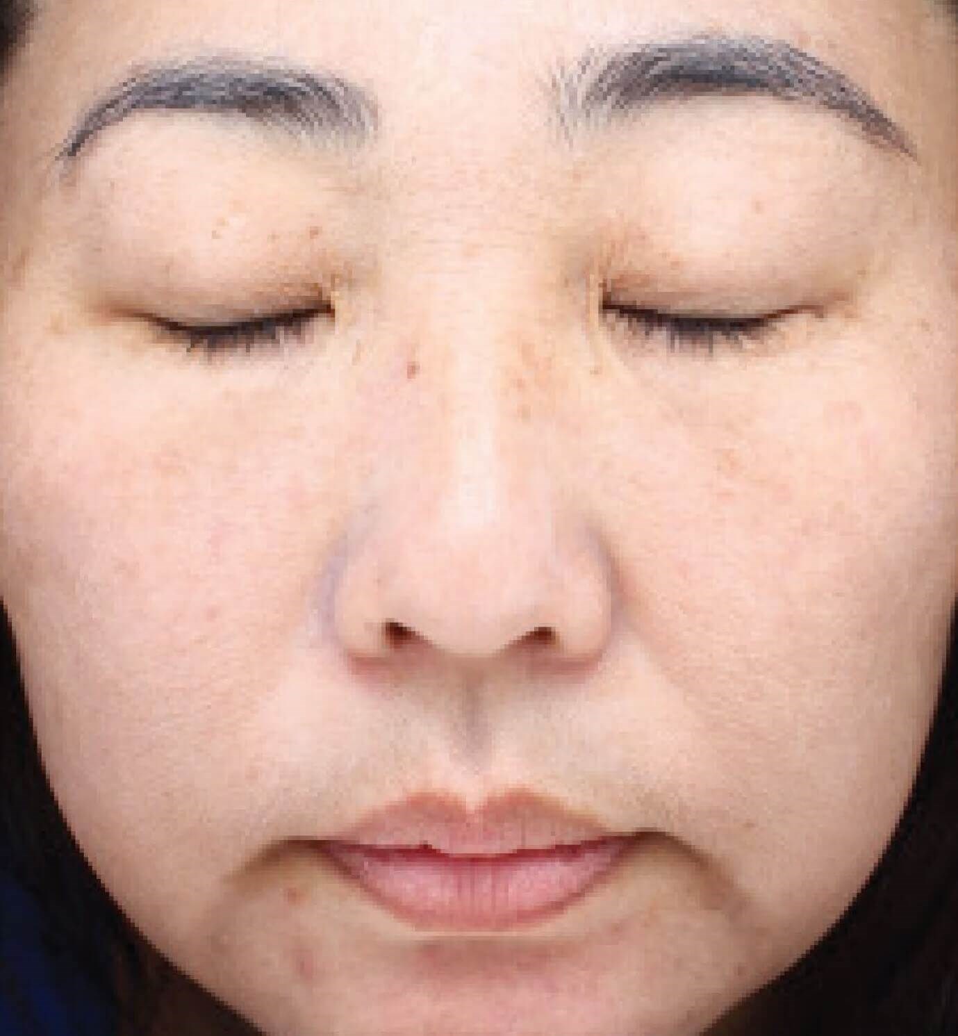 BBL and Halo  Laser After
