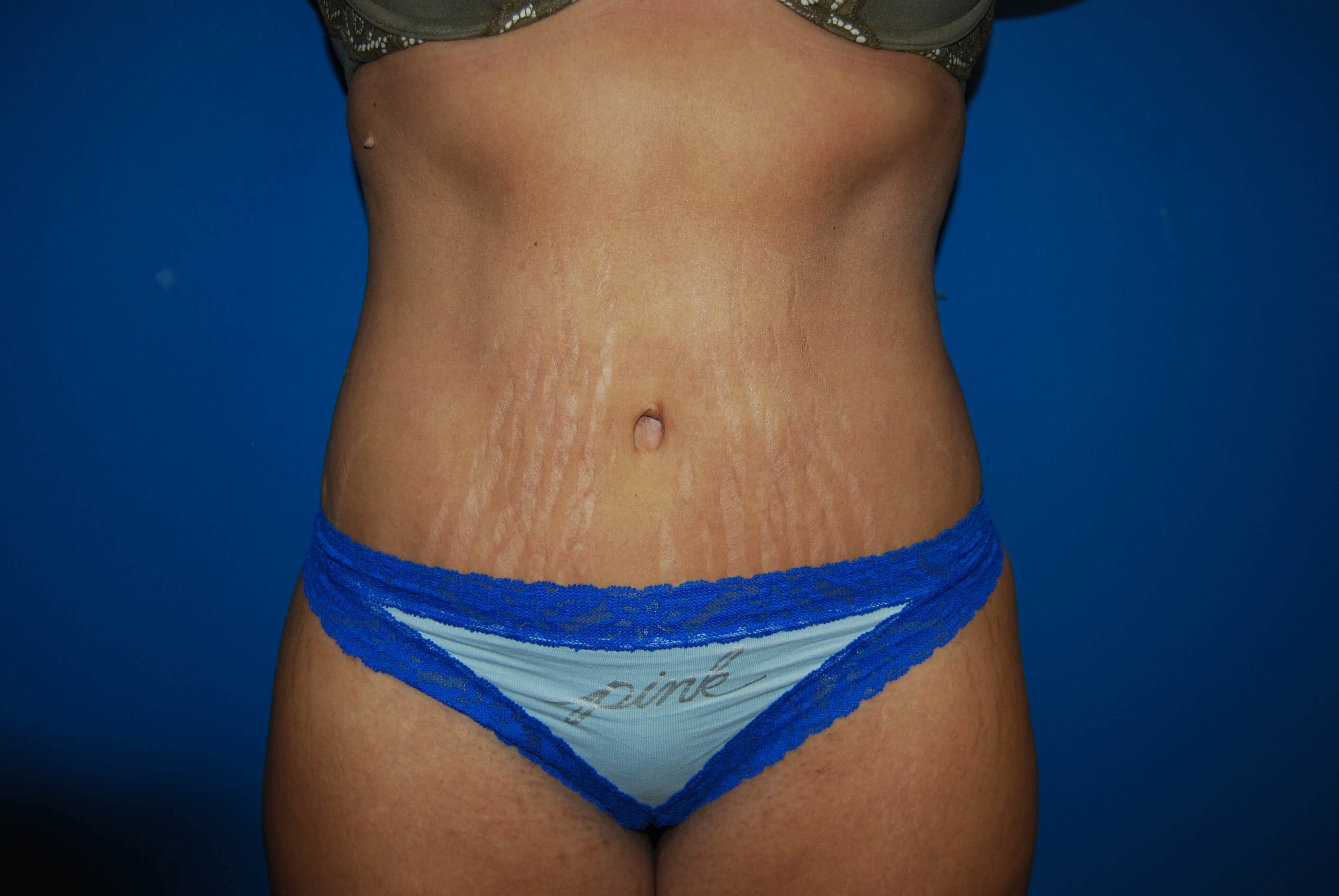 Front After