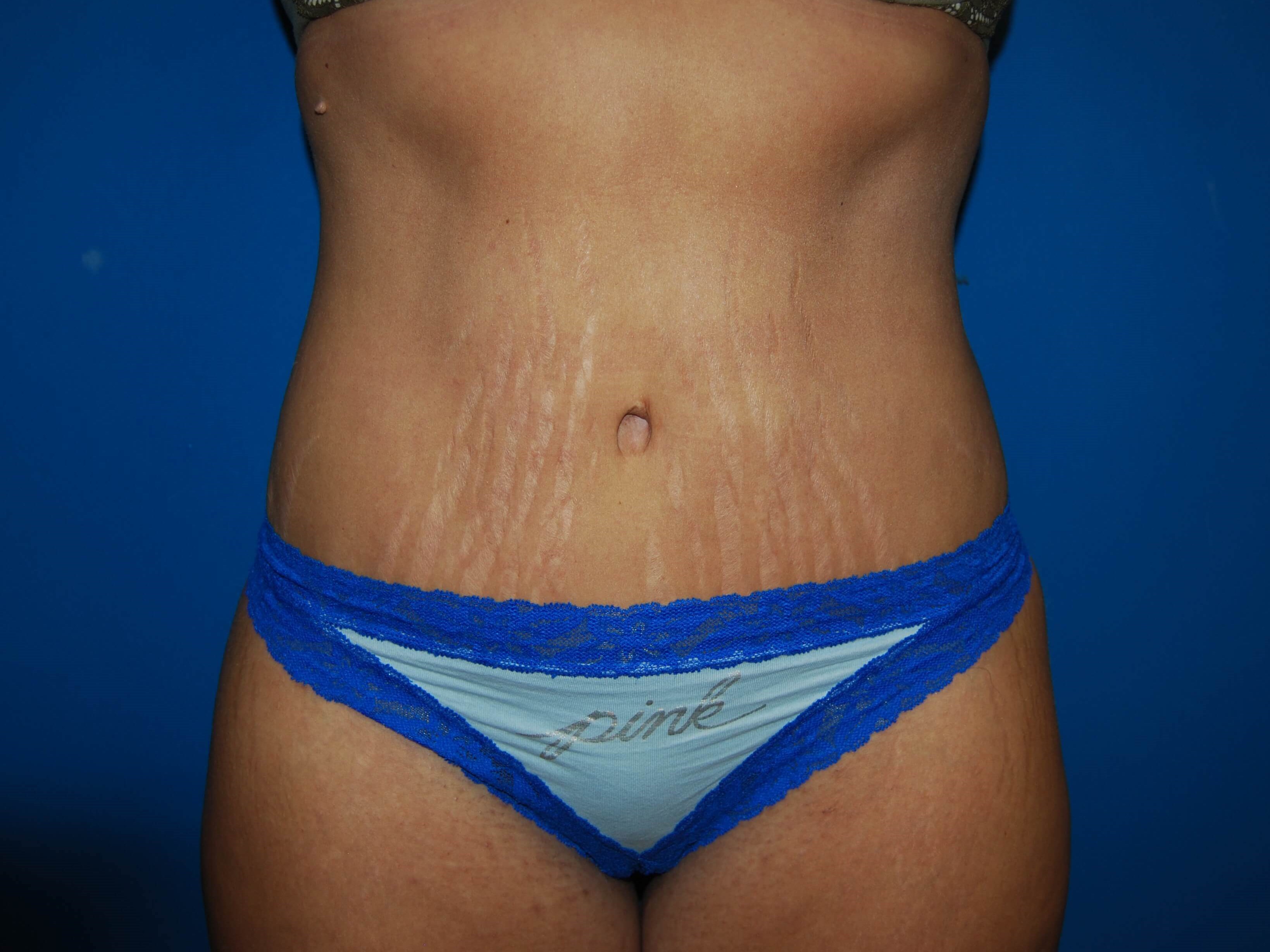 Front After