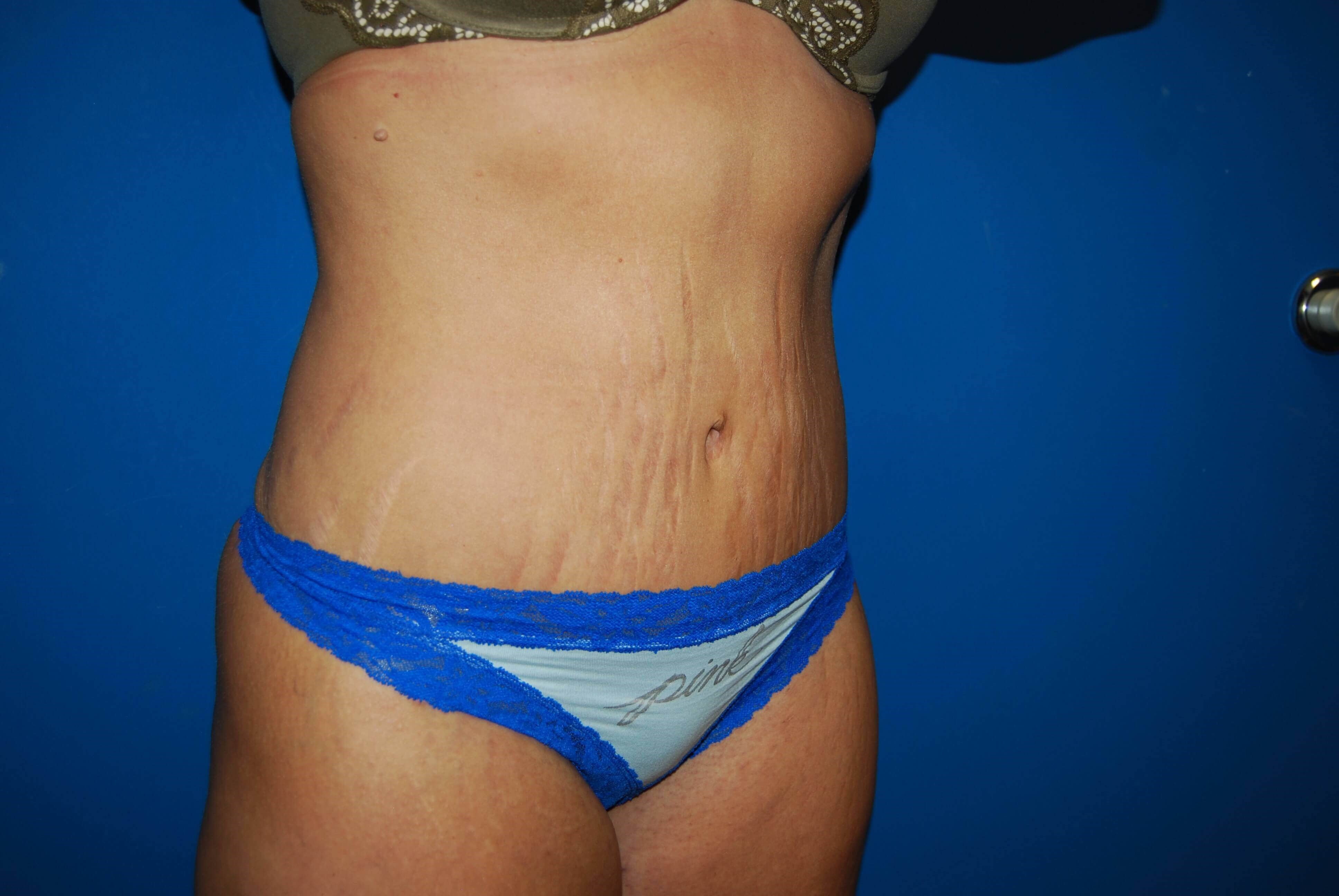 Oblique-Right After