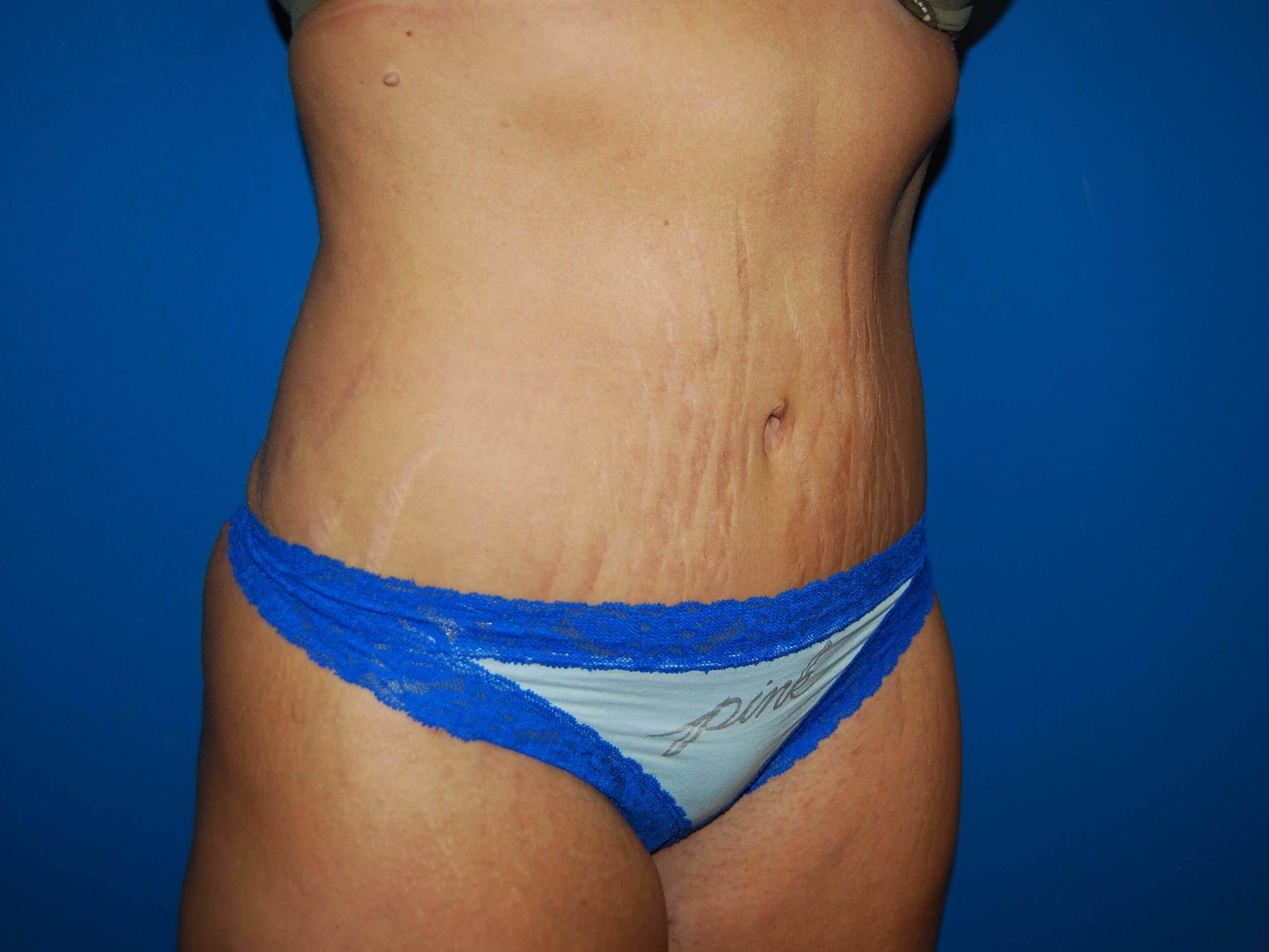 Oblique-Right After