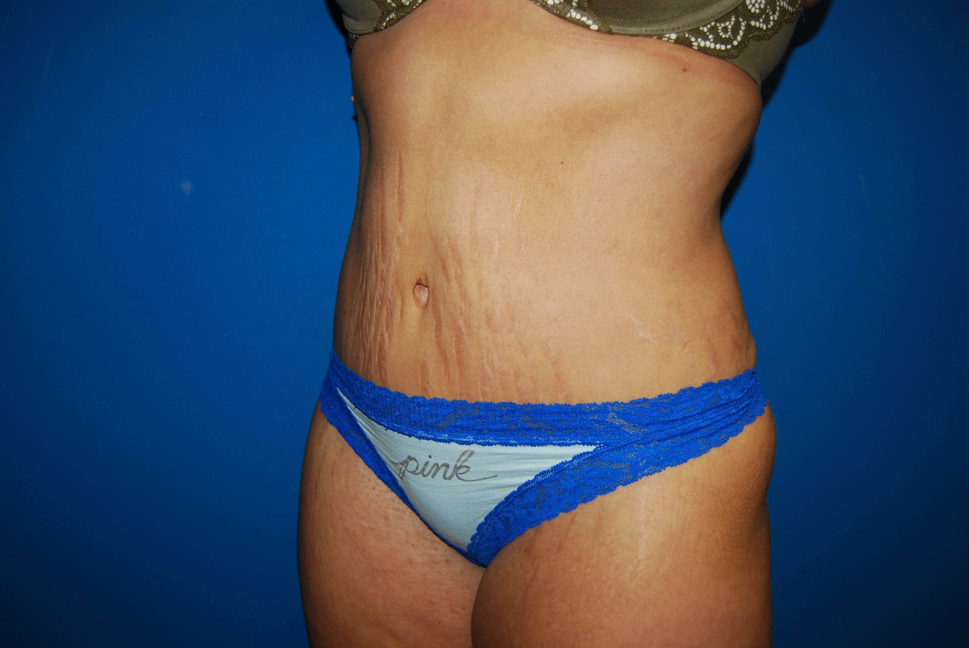 Oblique-Left After