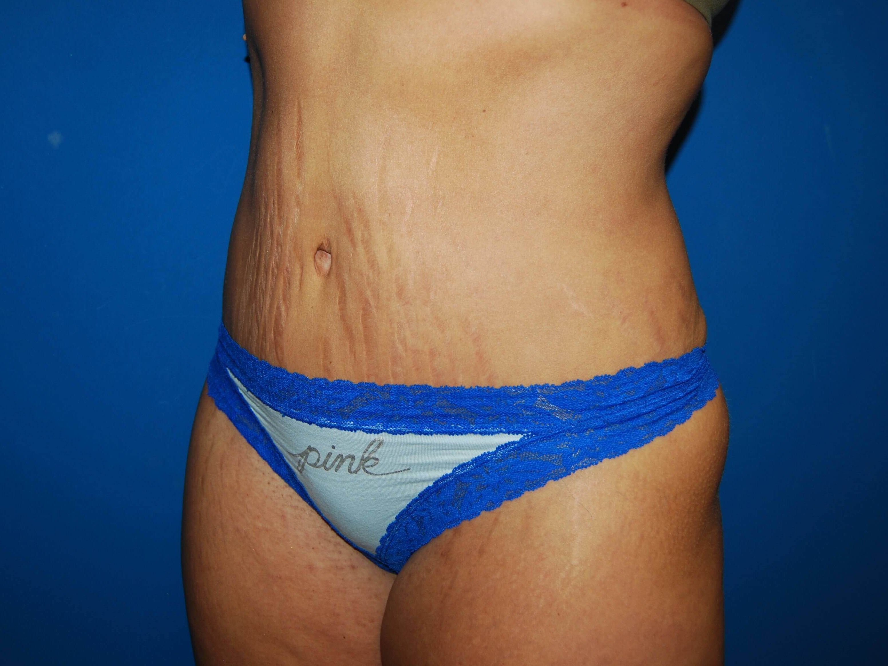 Oblique-Left After