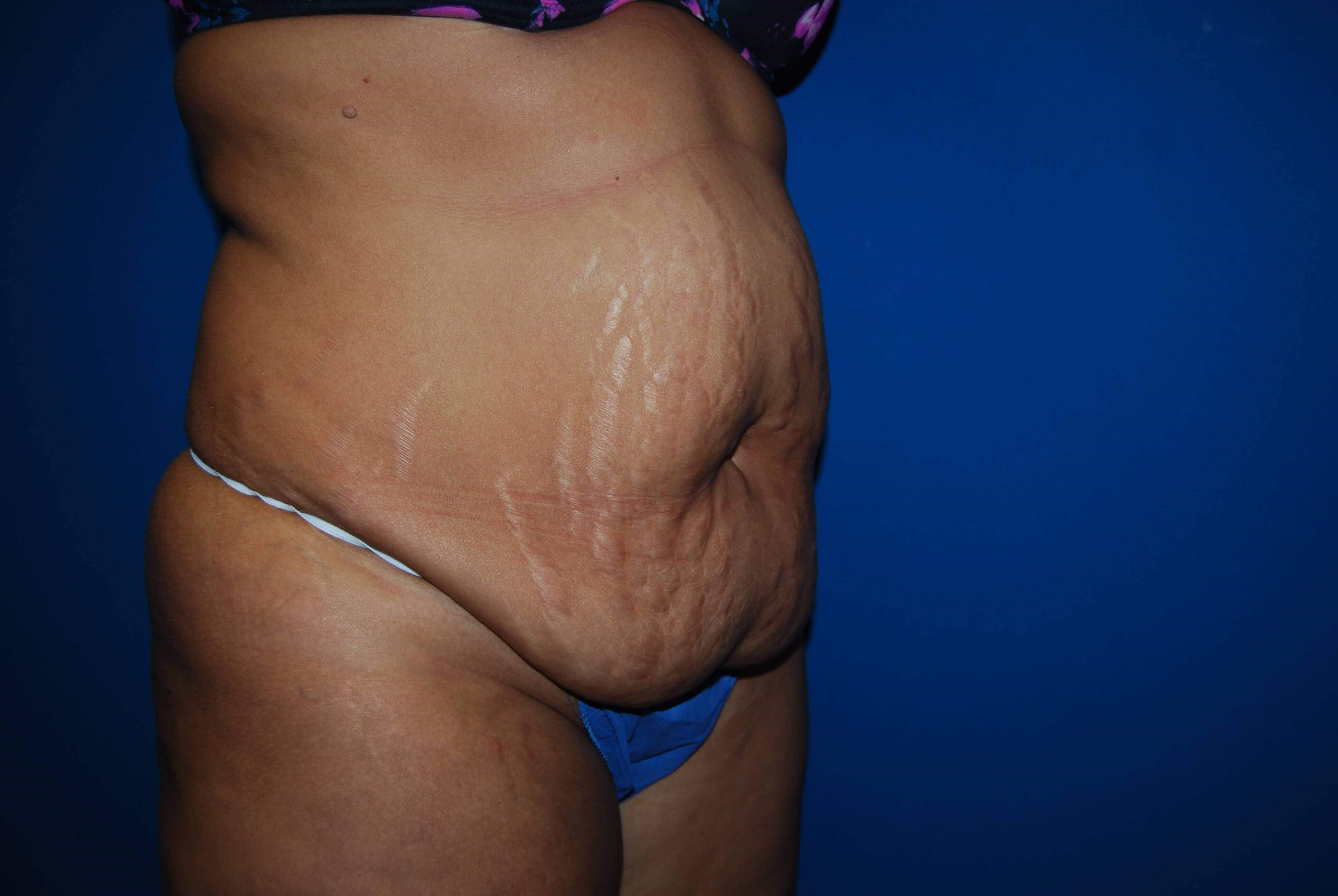 Oblique-Right Before