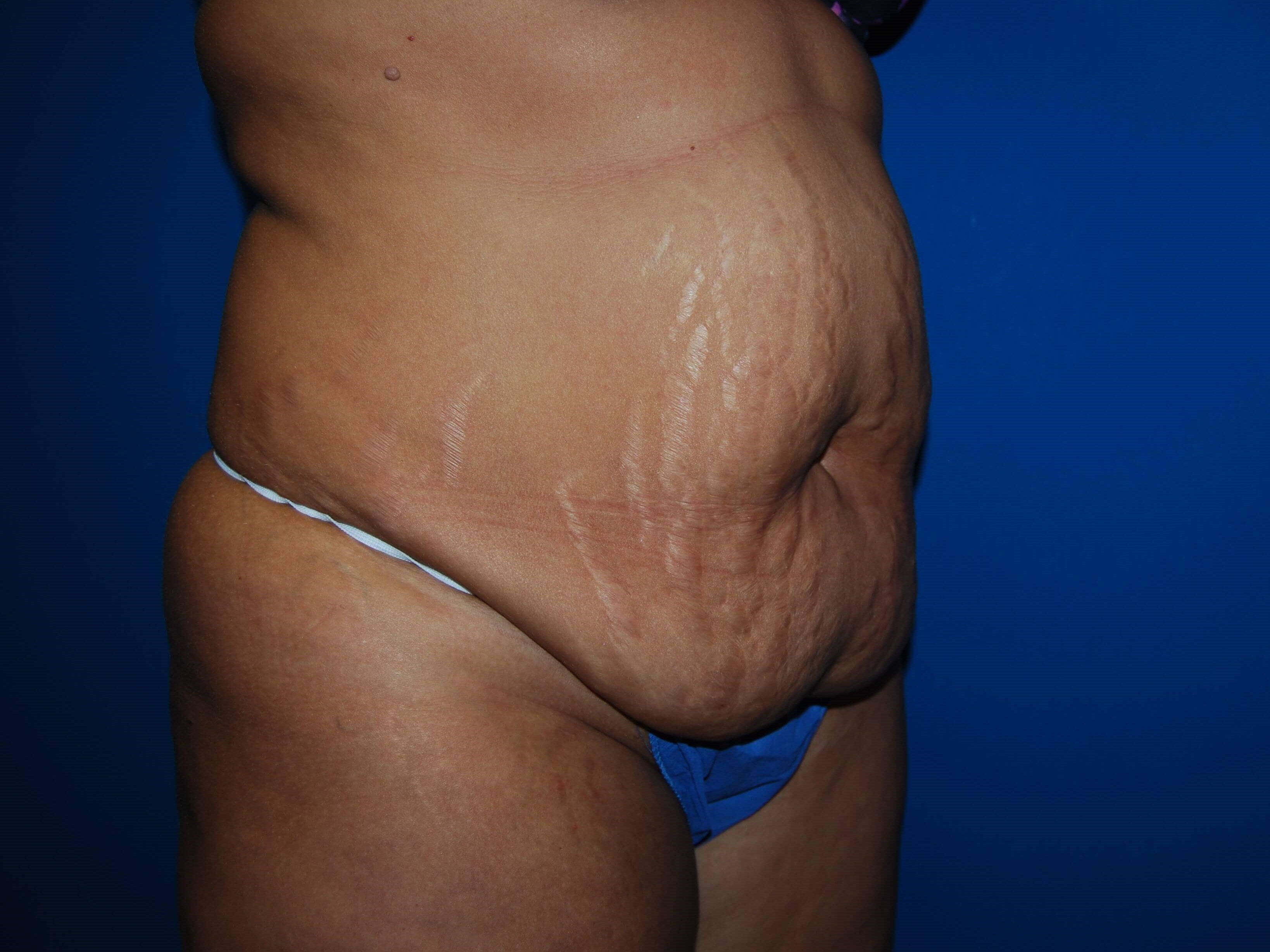 Oblique-Right Before