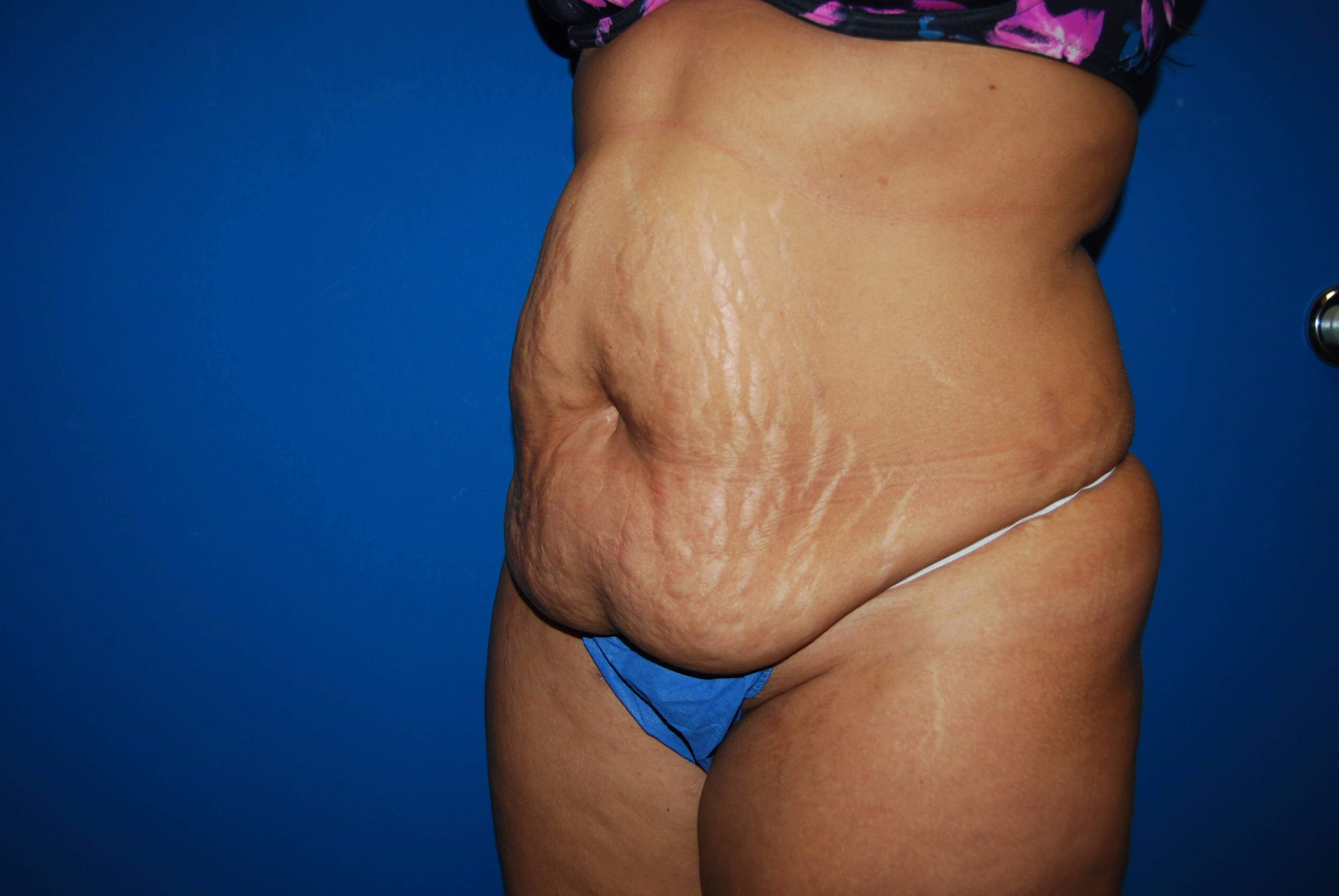 Oblique-Left Before