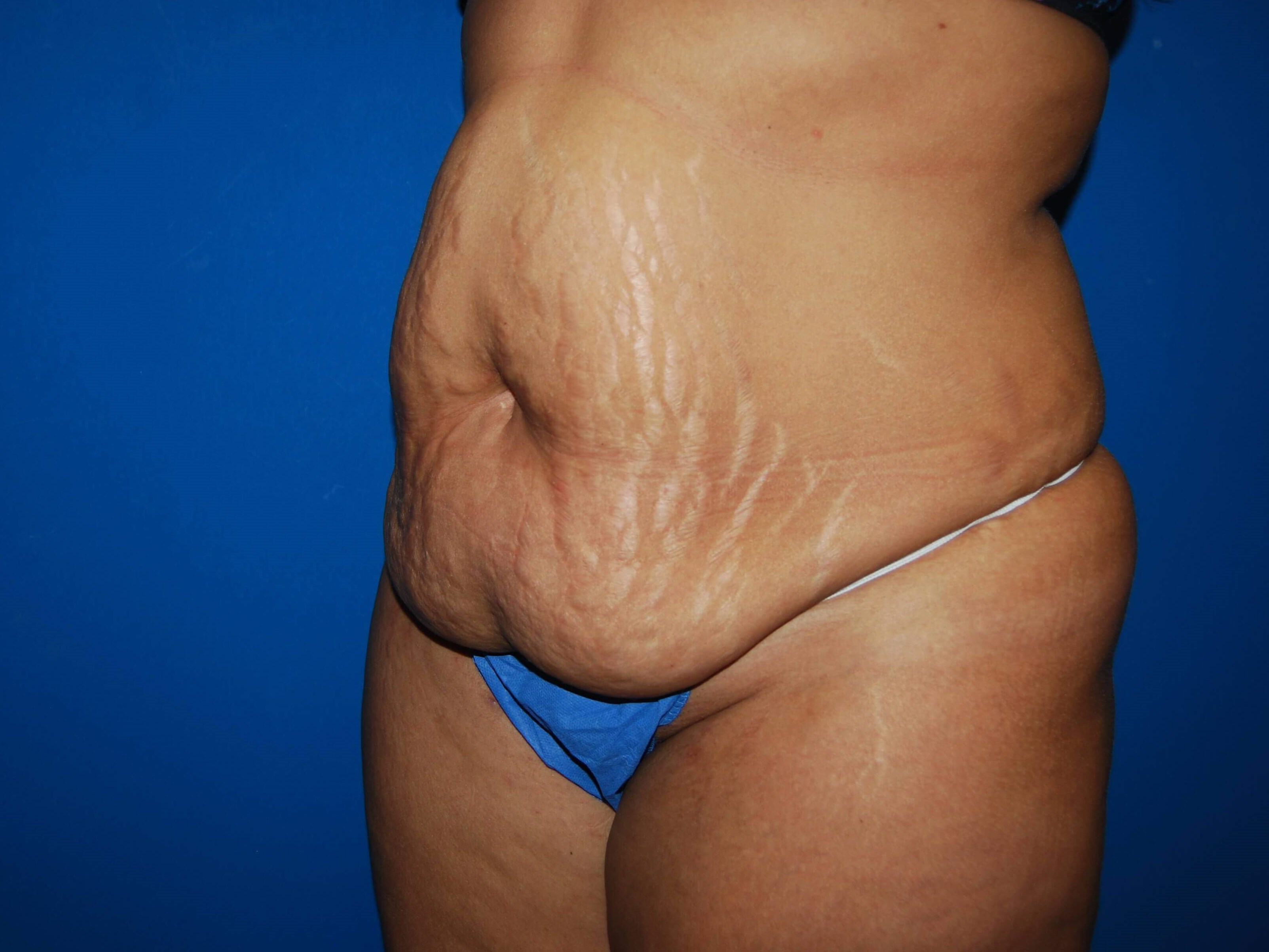 Oblique-Left Before
