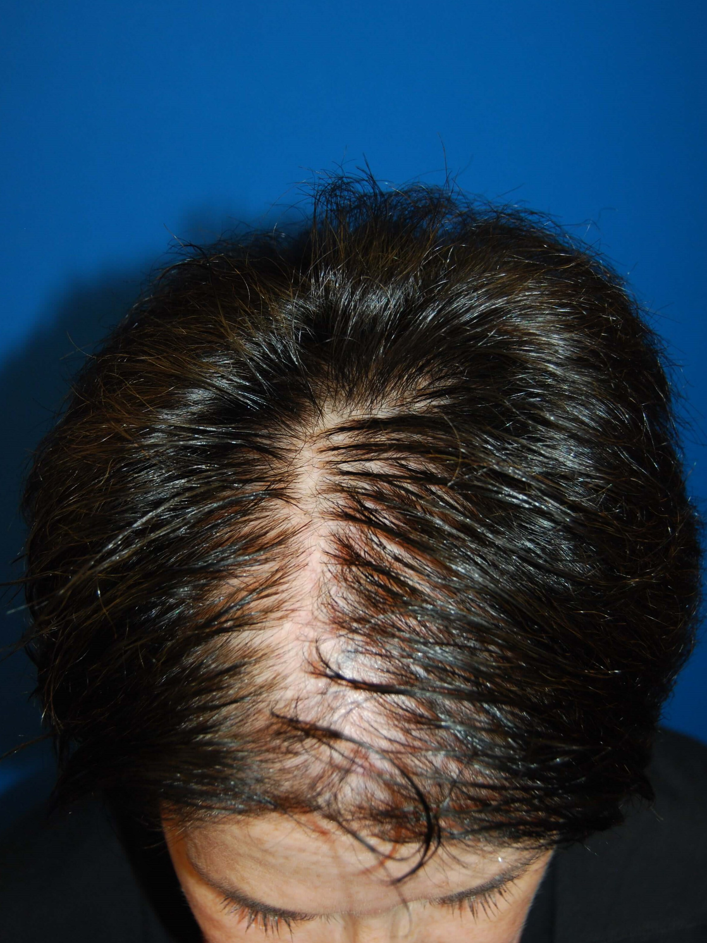 Front Before Hair Transplant