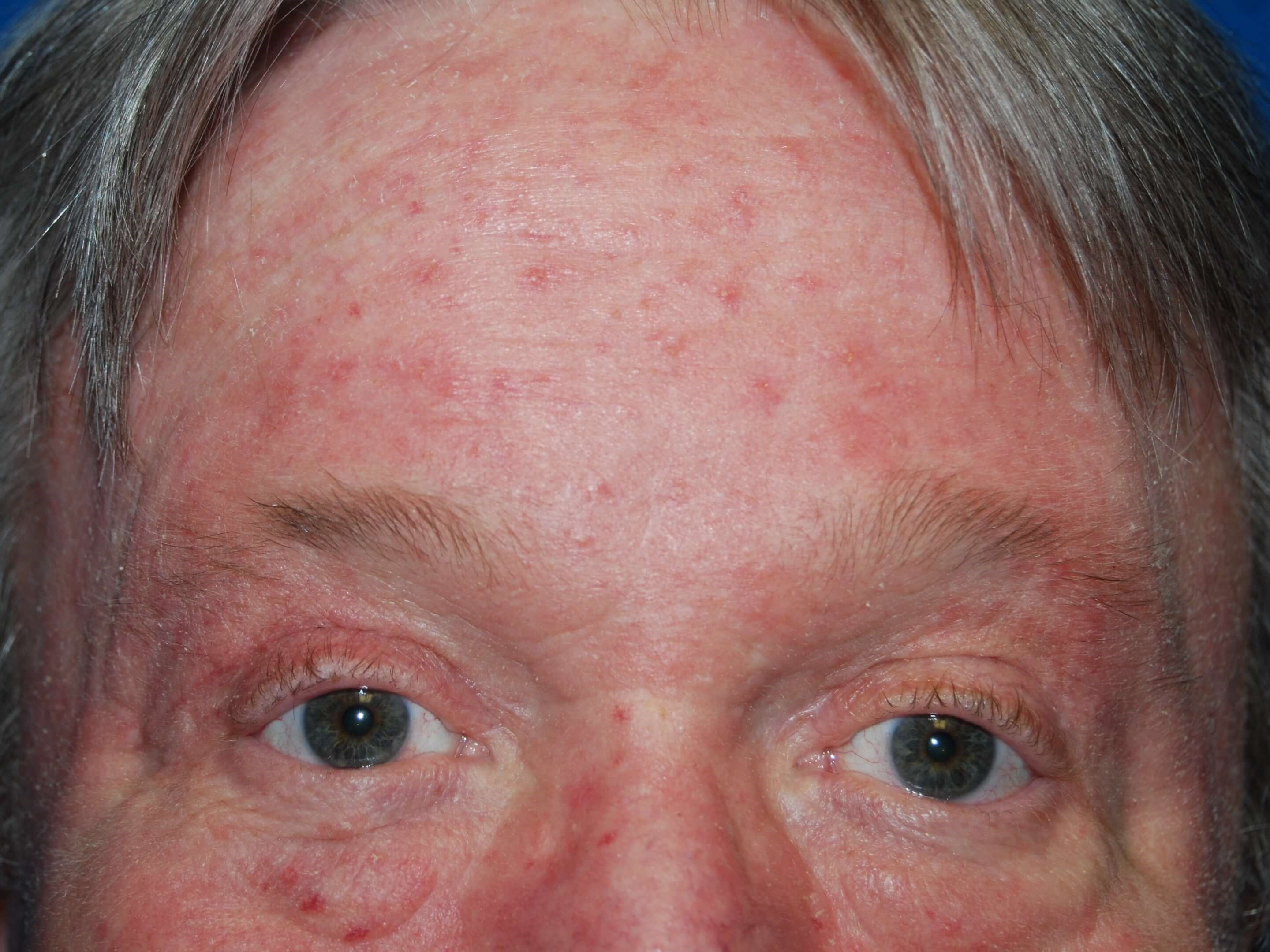 Front View After