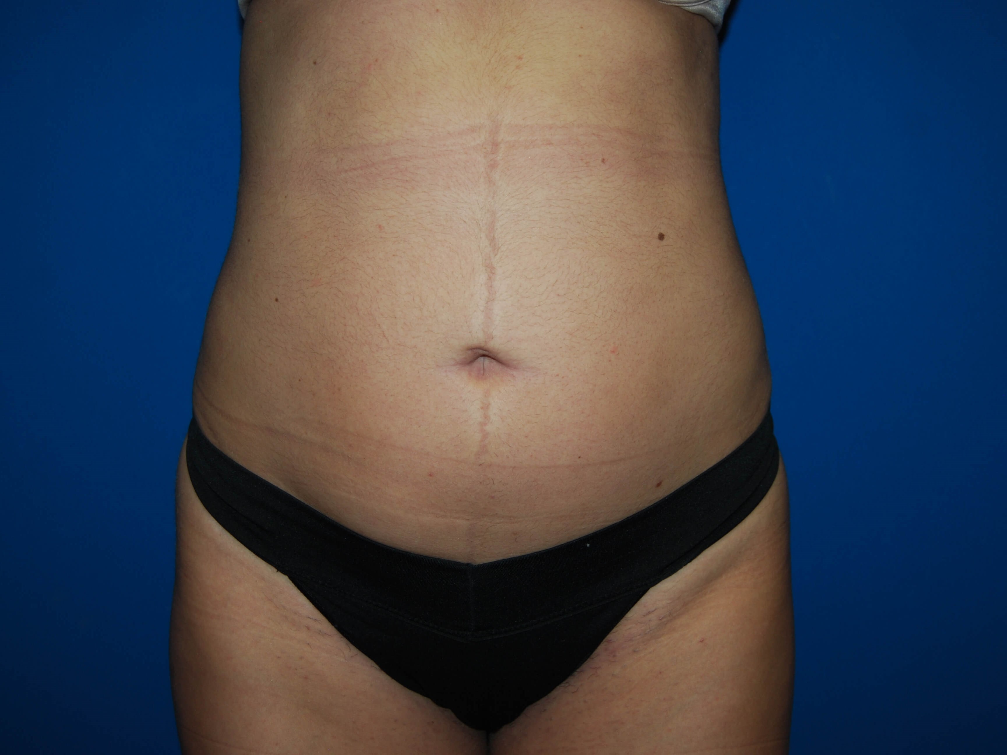 Front After  Liposuction