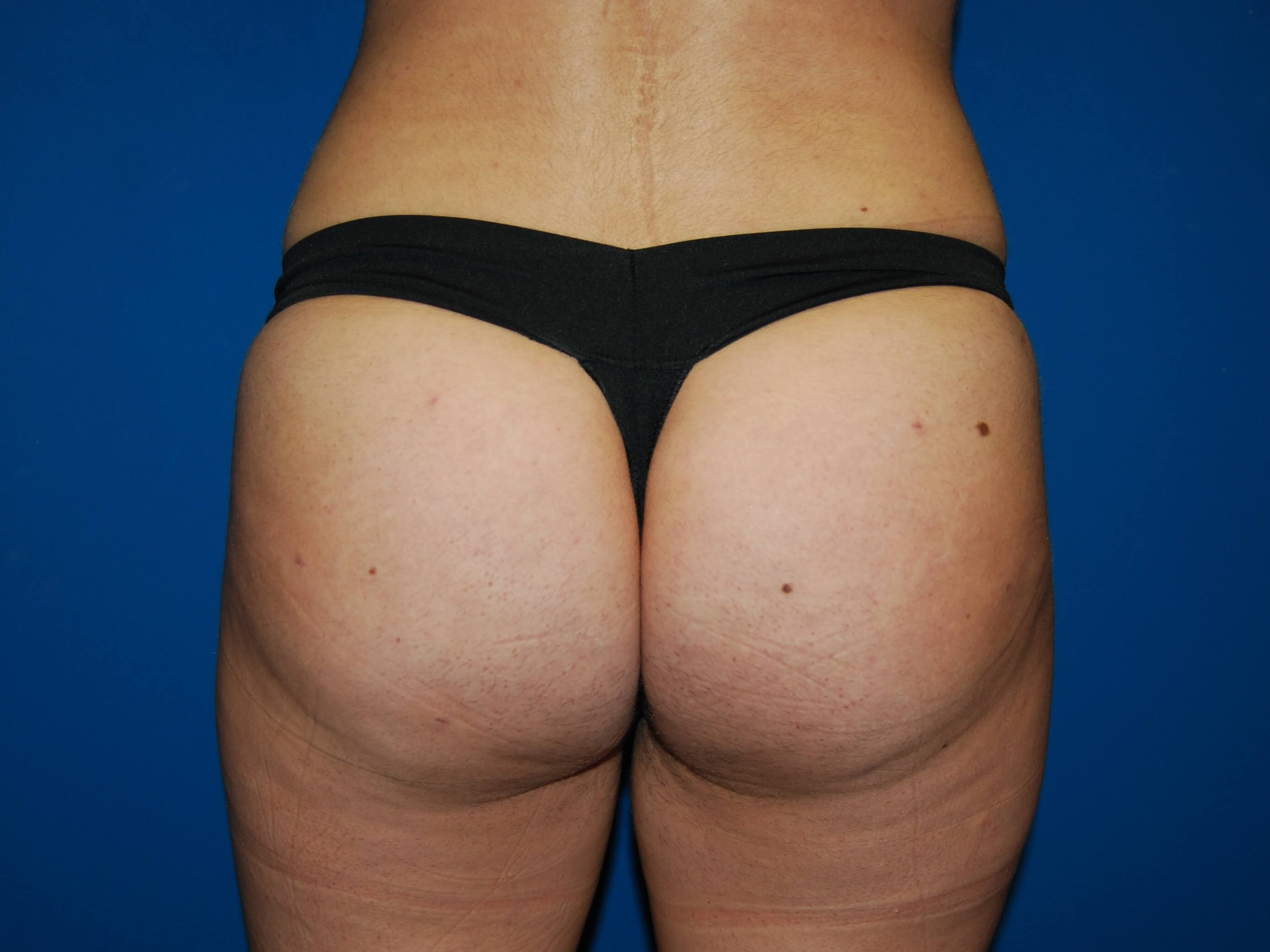 Back View After BBL