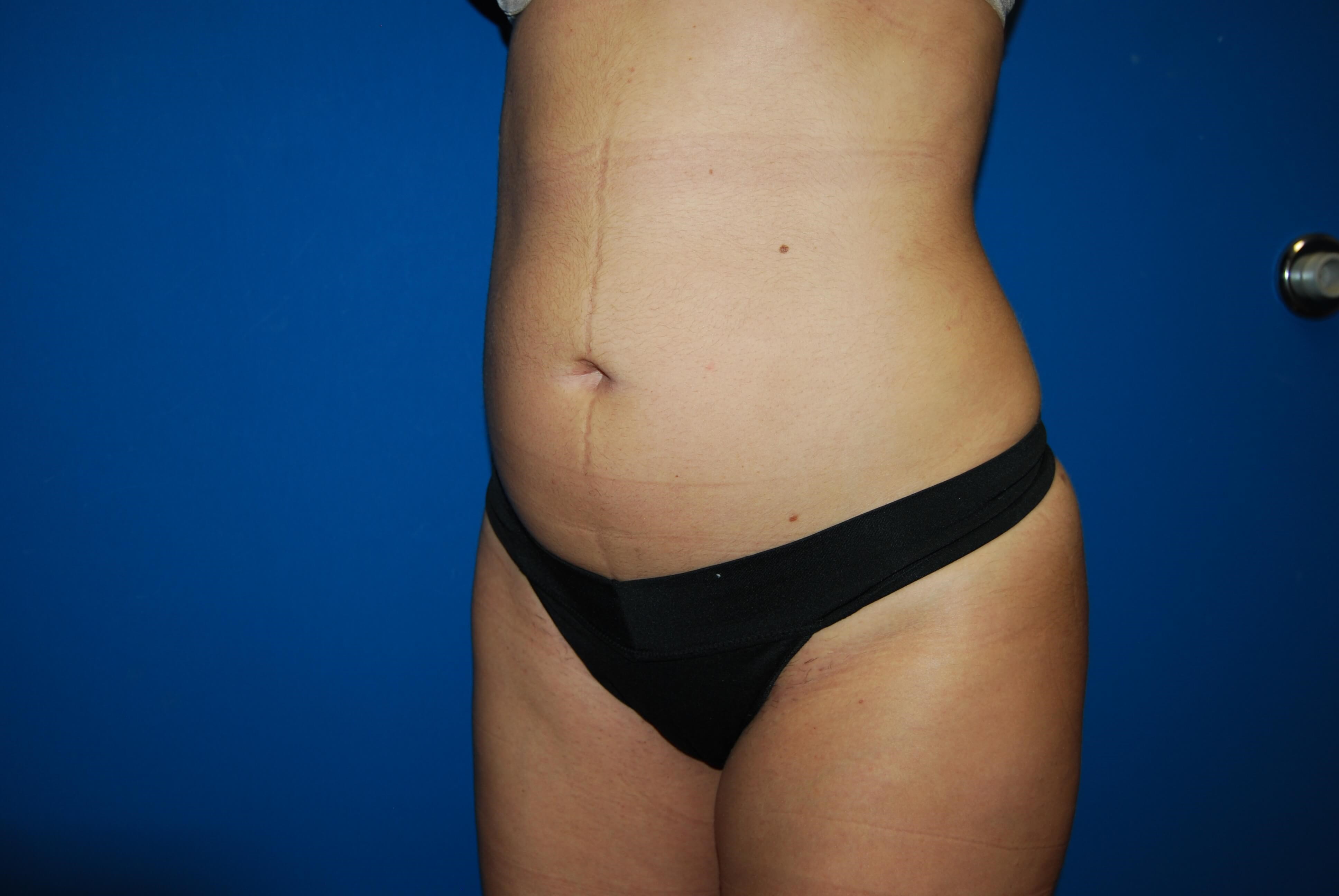 Oblique - Left After Liposuction