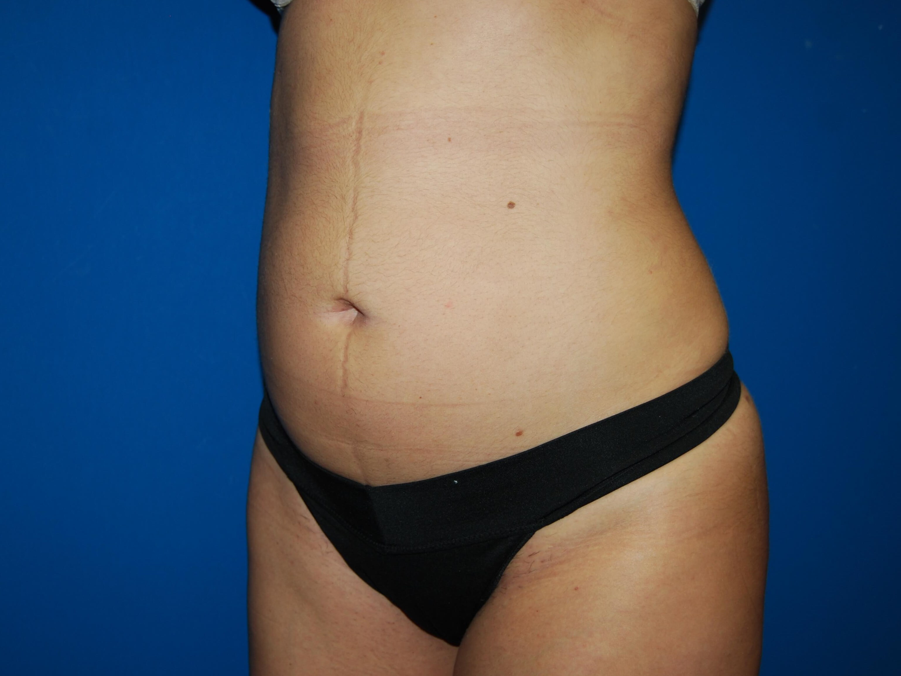 Oblique - Left After Liposuction