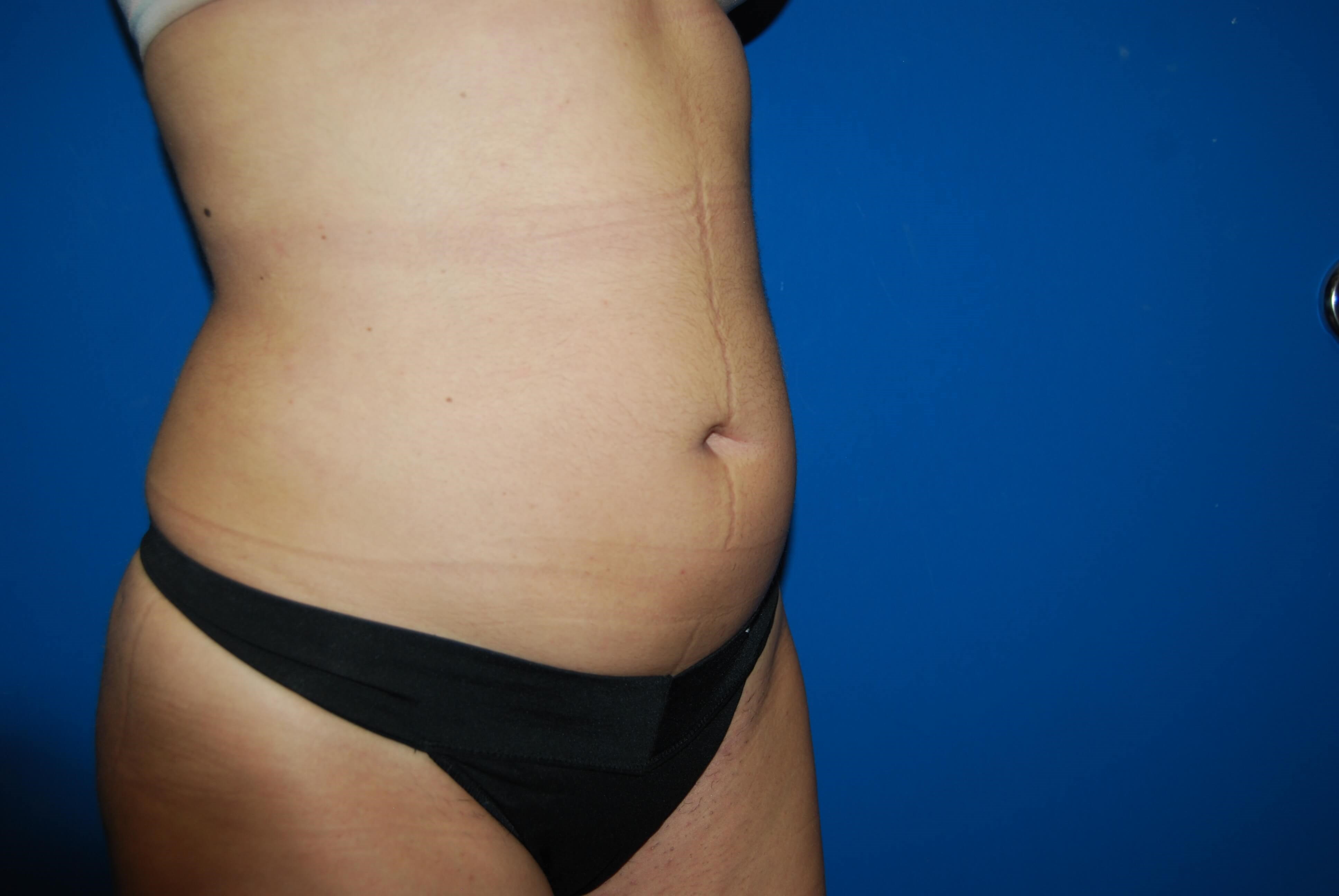 Oblique - Right After Liposuction