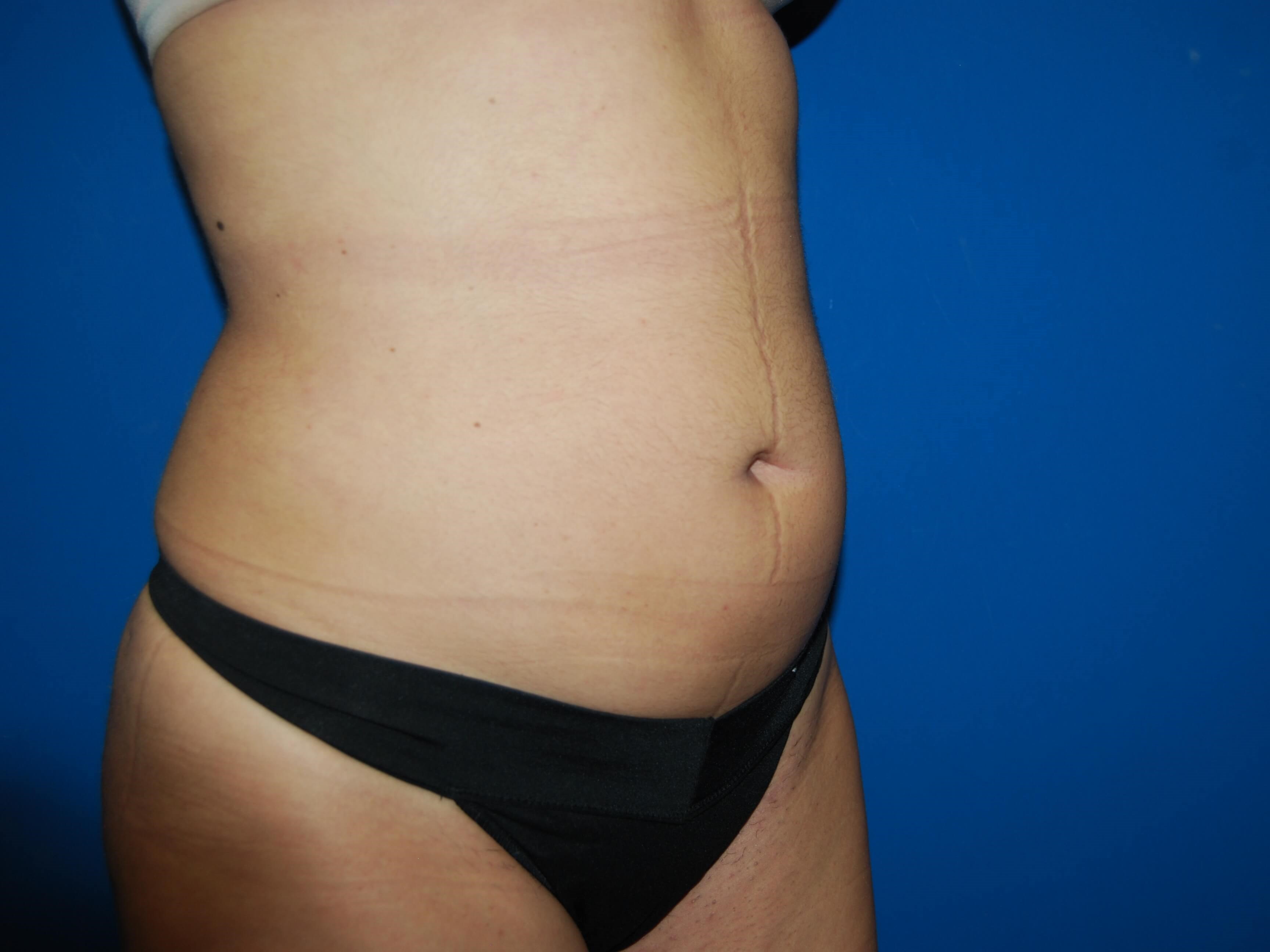 Oblique - Right After Liposuction