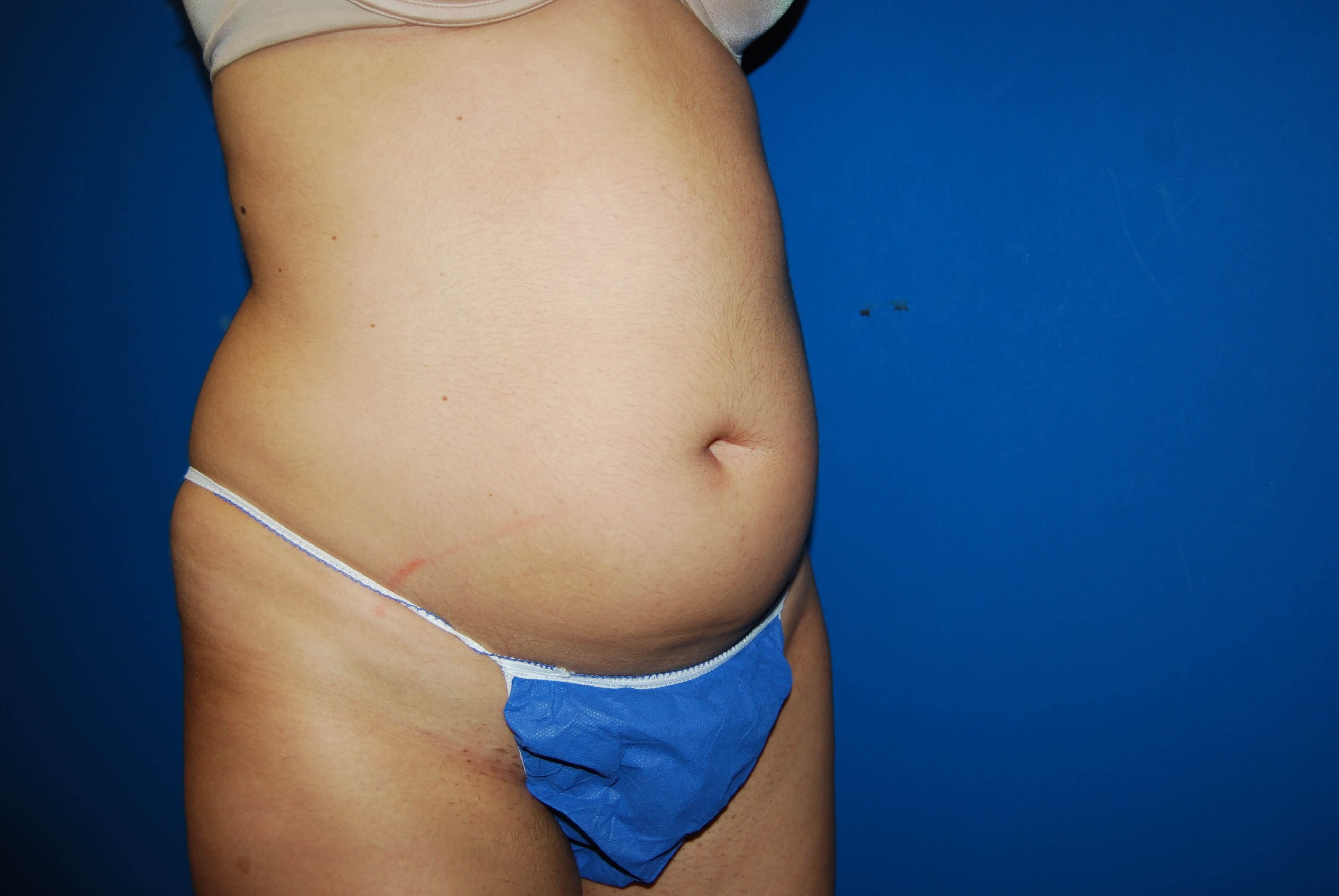 Oblique - Right Before Liposuction