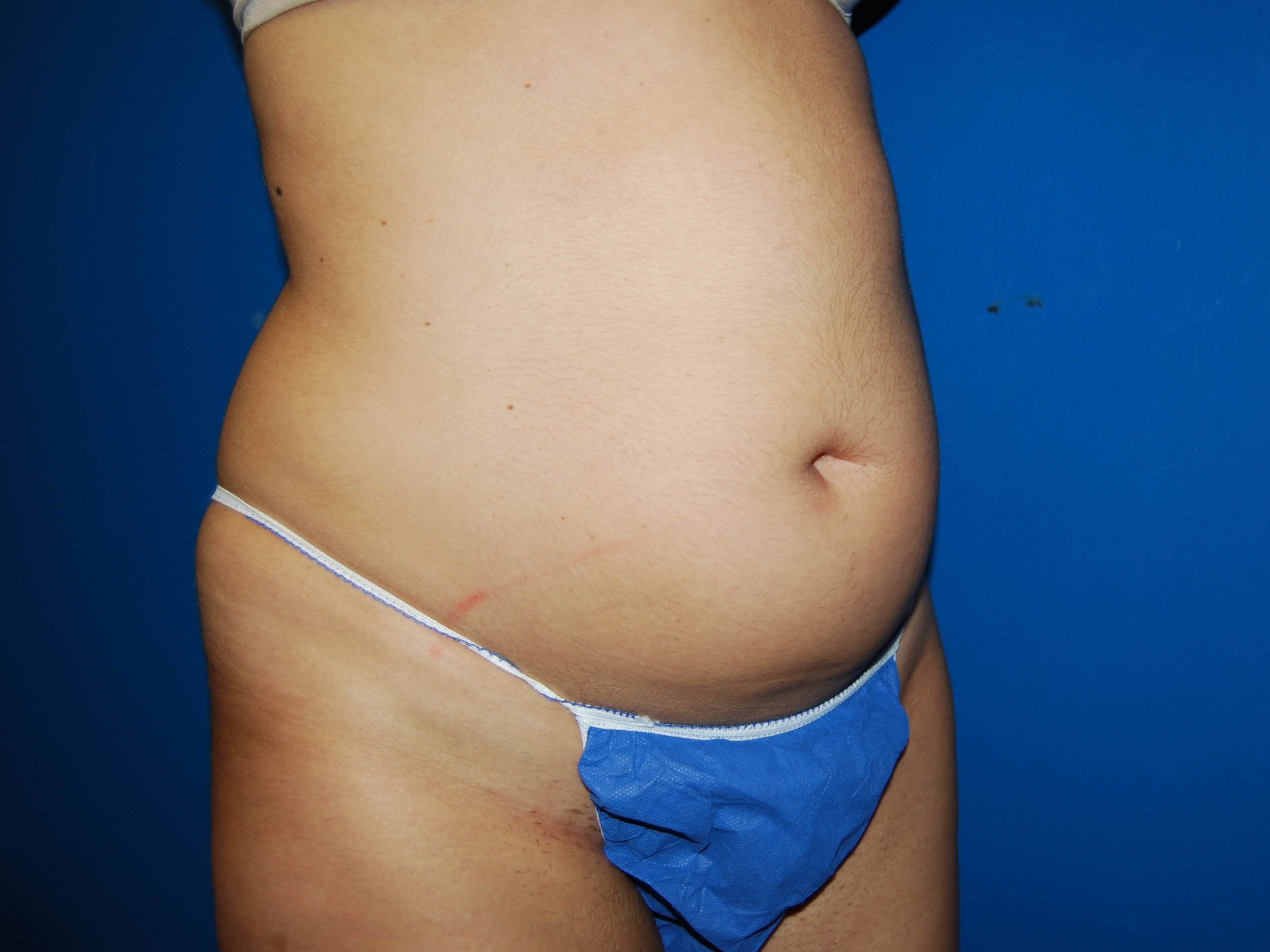 Oblique - Right Before Liposuction