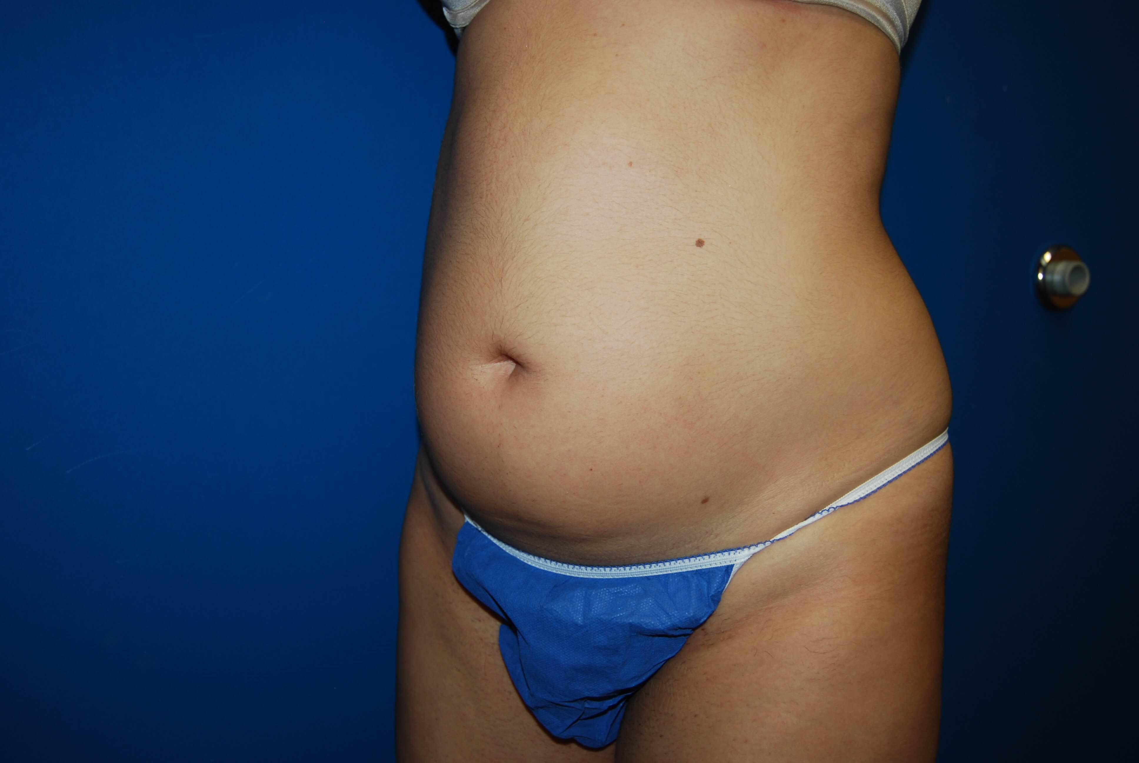 Oblique - Left Before Liposuction