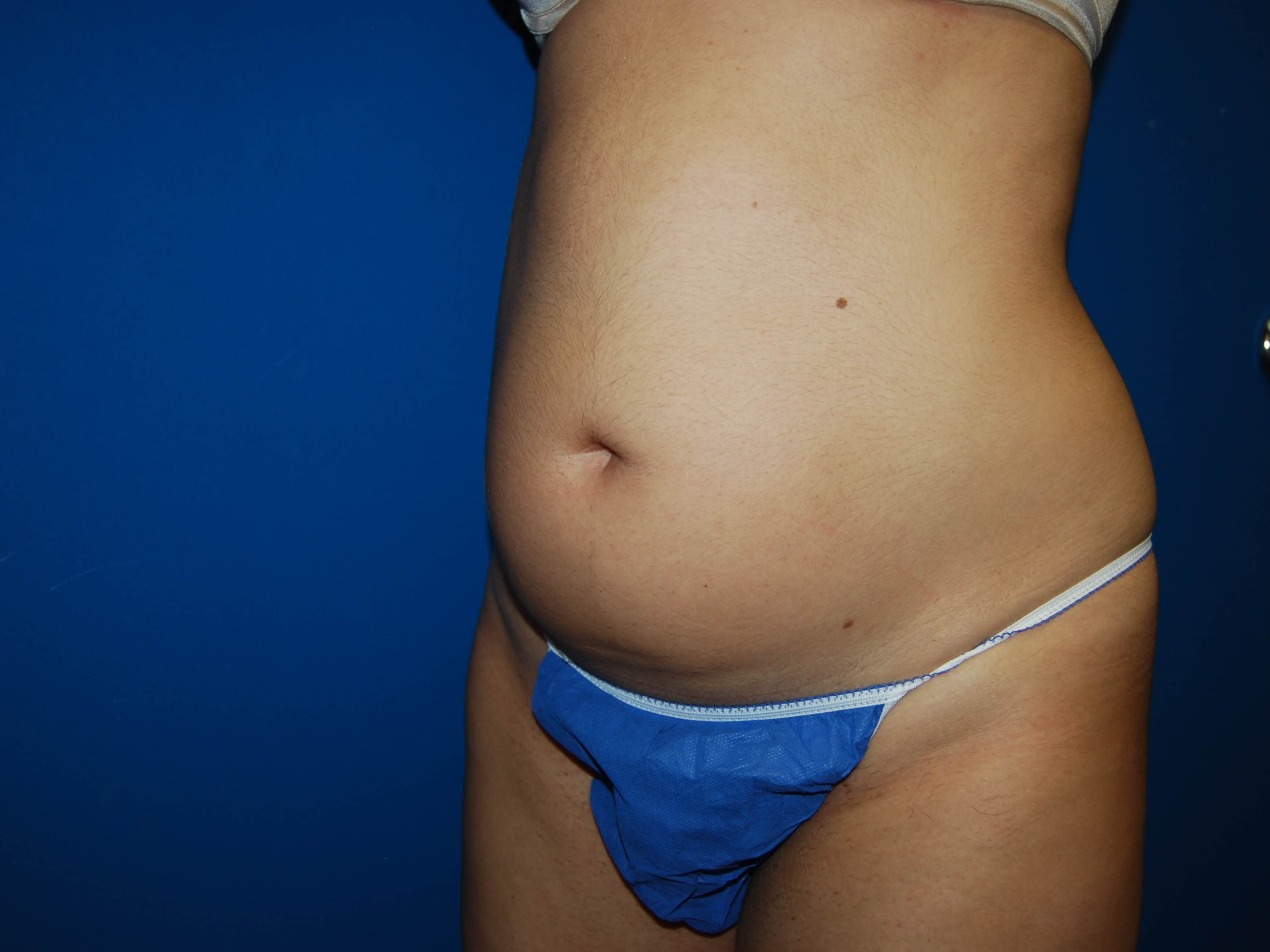 Oblique - Left Before Liposuction